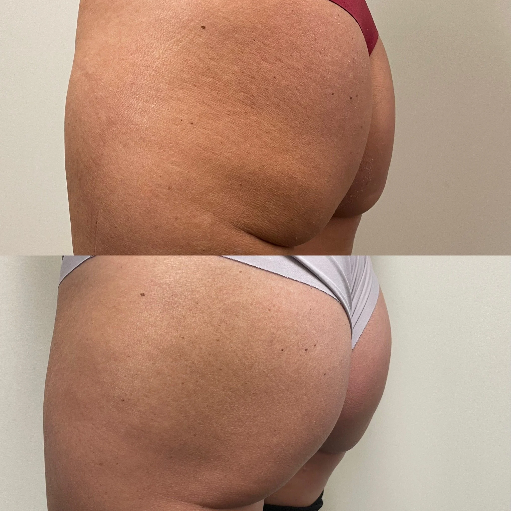 Injectable BBL before and after at Novirra in Columbus, Ohio. Located in the Short North. 