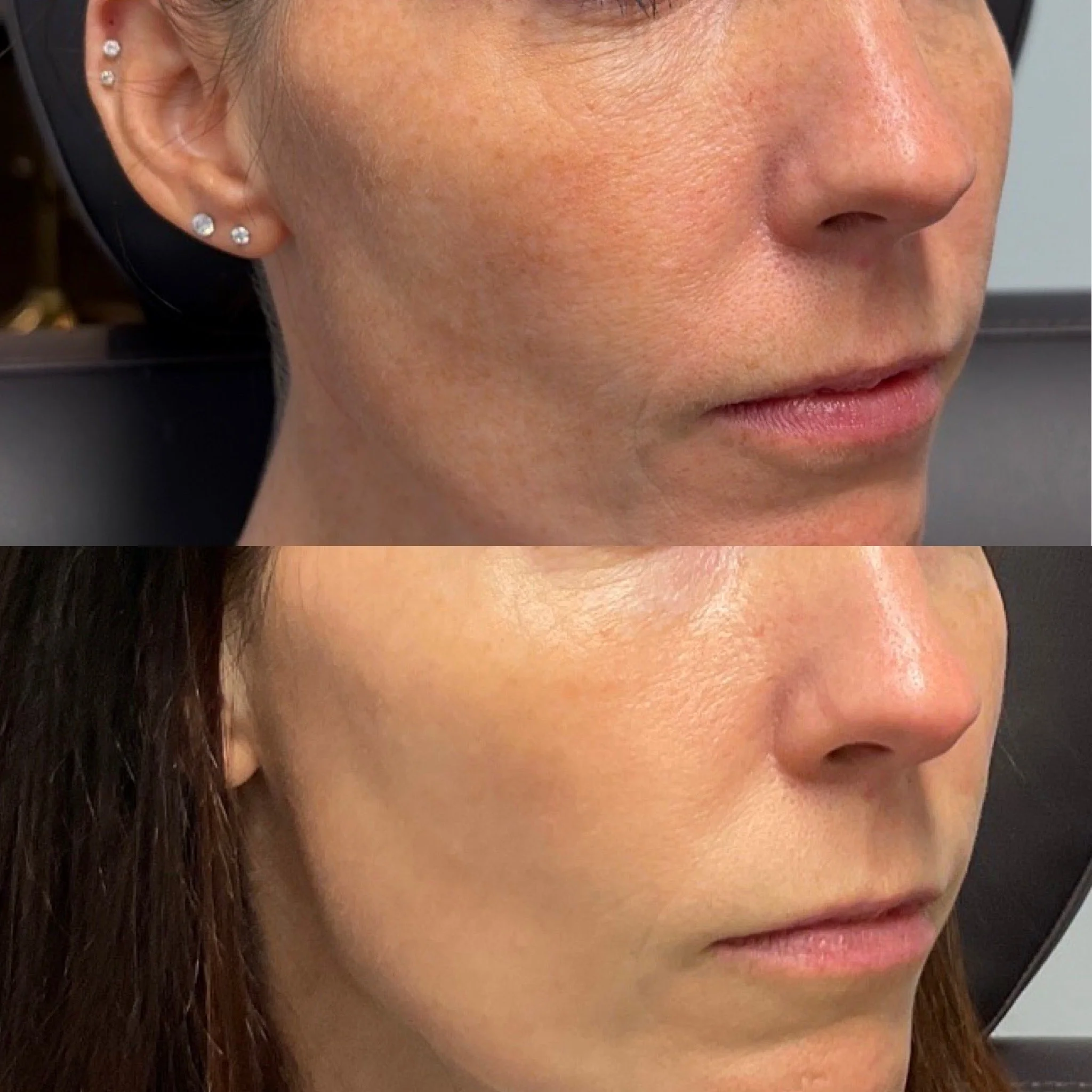 Skin quality before and after Microneedling with Exosomes at Novirra in Columbus, Ohio. Located in the Short North. 
