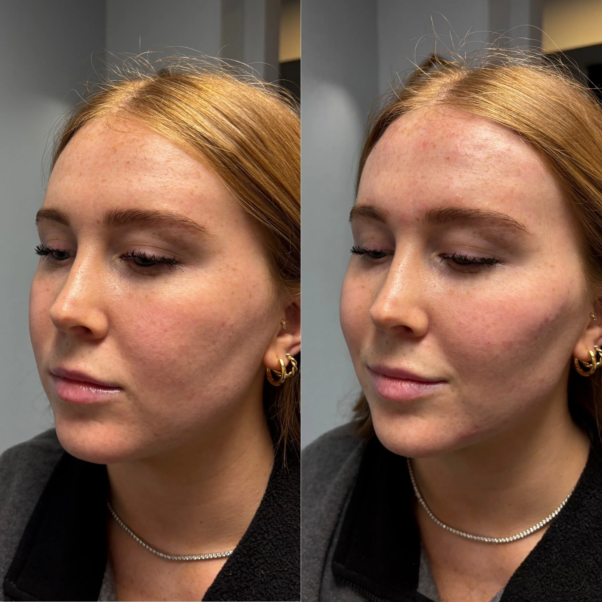 Facial balancing dermal filler before and after at Novirra in Columbus, Ohio. Located in the Short North. 