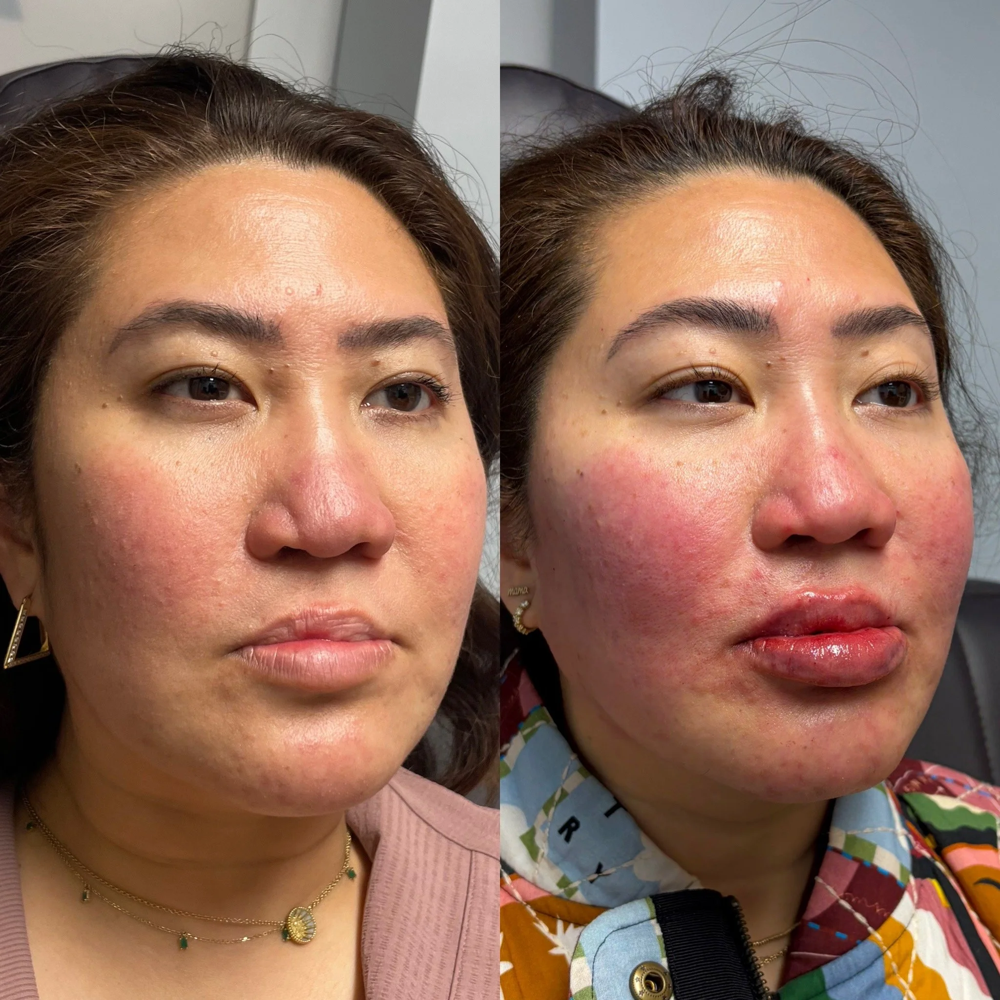 
Facial balancing dermal filler before and after at Novirra in Columbus, Ohio. Located in the Short North.