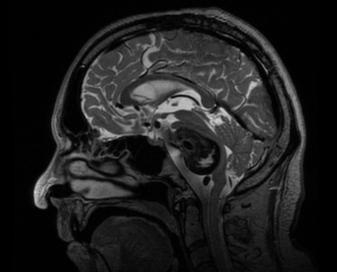 MRI scan of a human brain with giant Basilar artery aneurysm