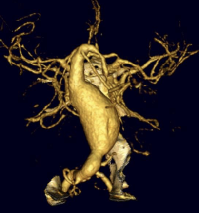 A 3D medical imaging scan showing a human aorta with branching arteries.