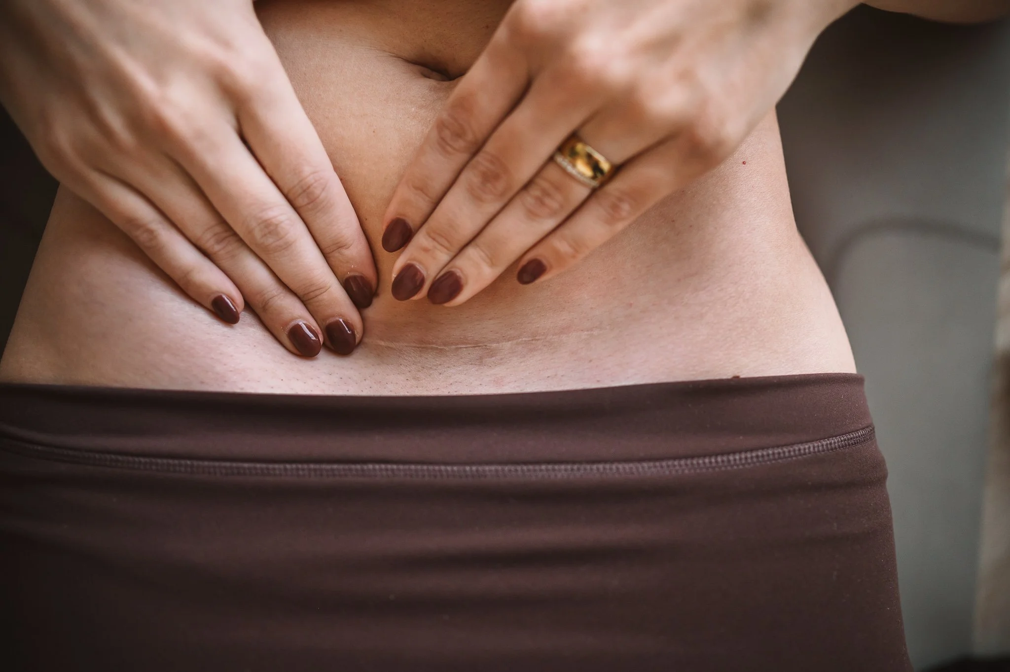 What Is C-Section Scar Therapy and How Does It Help Recovery?