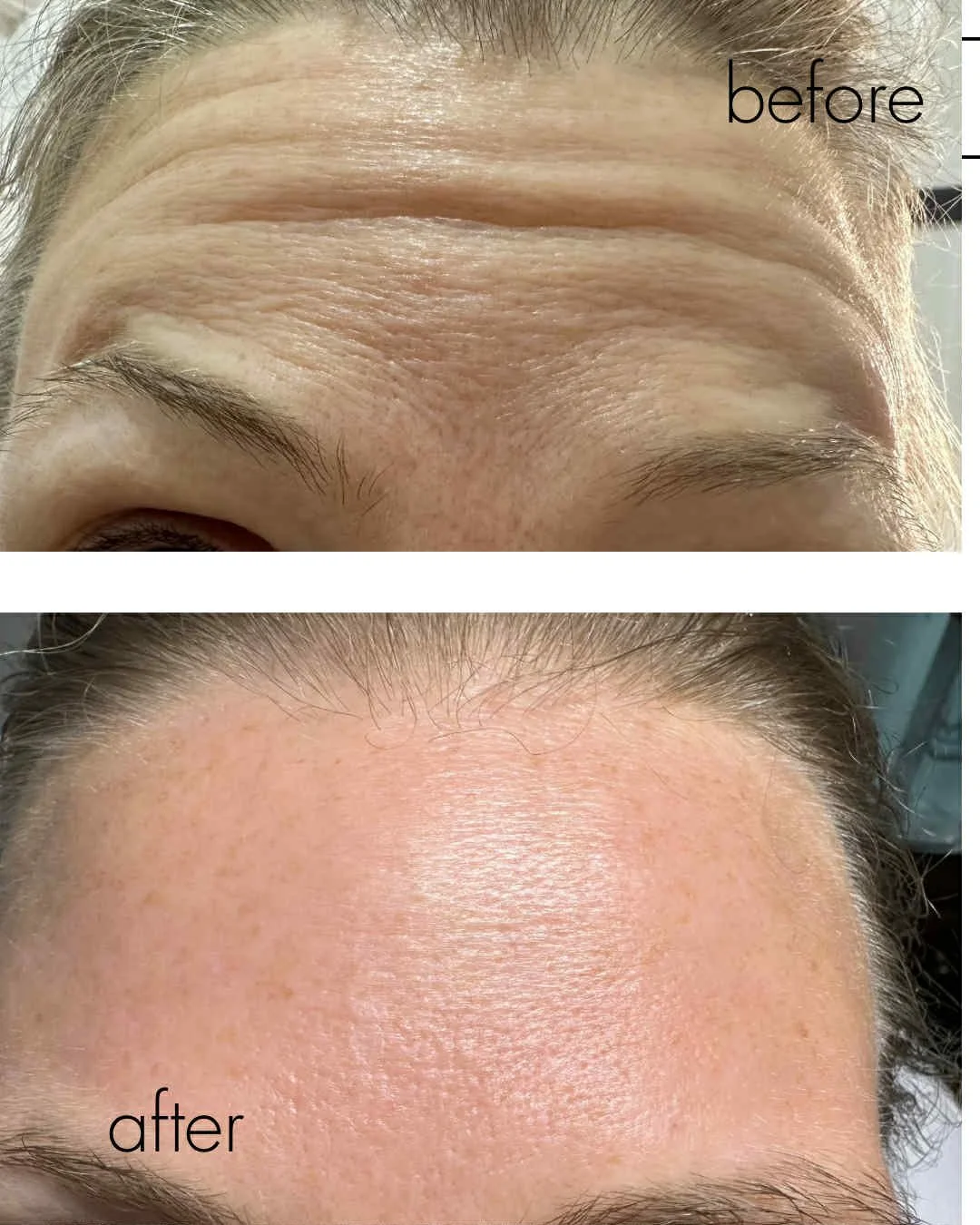 Anti-Wrinkle Injections