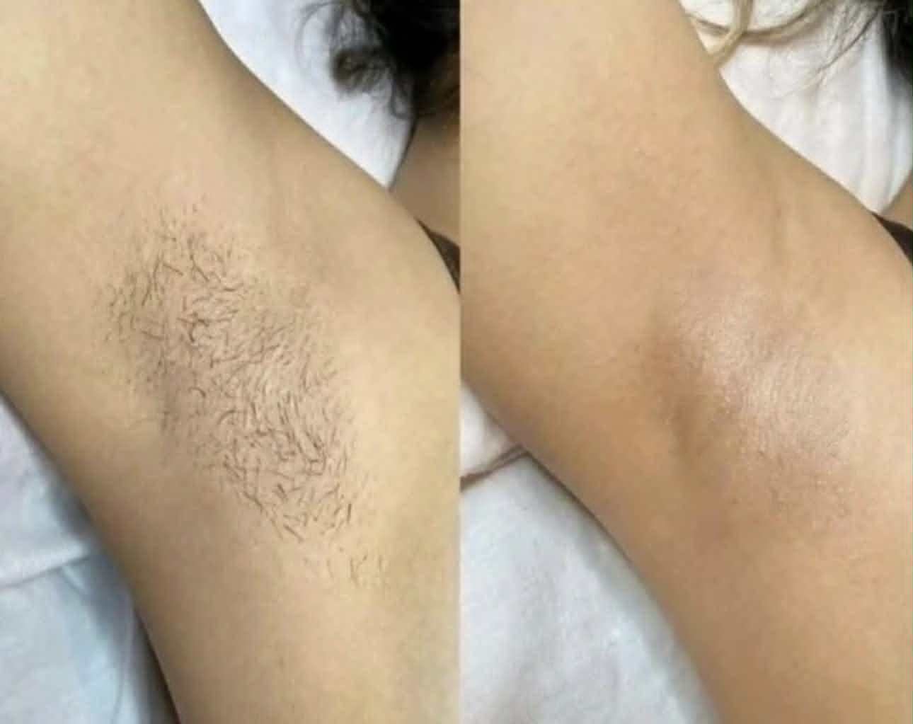 Laser Hair Removal