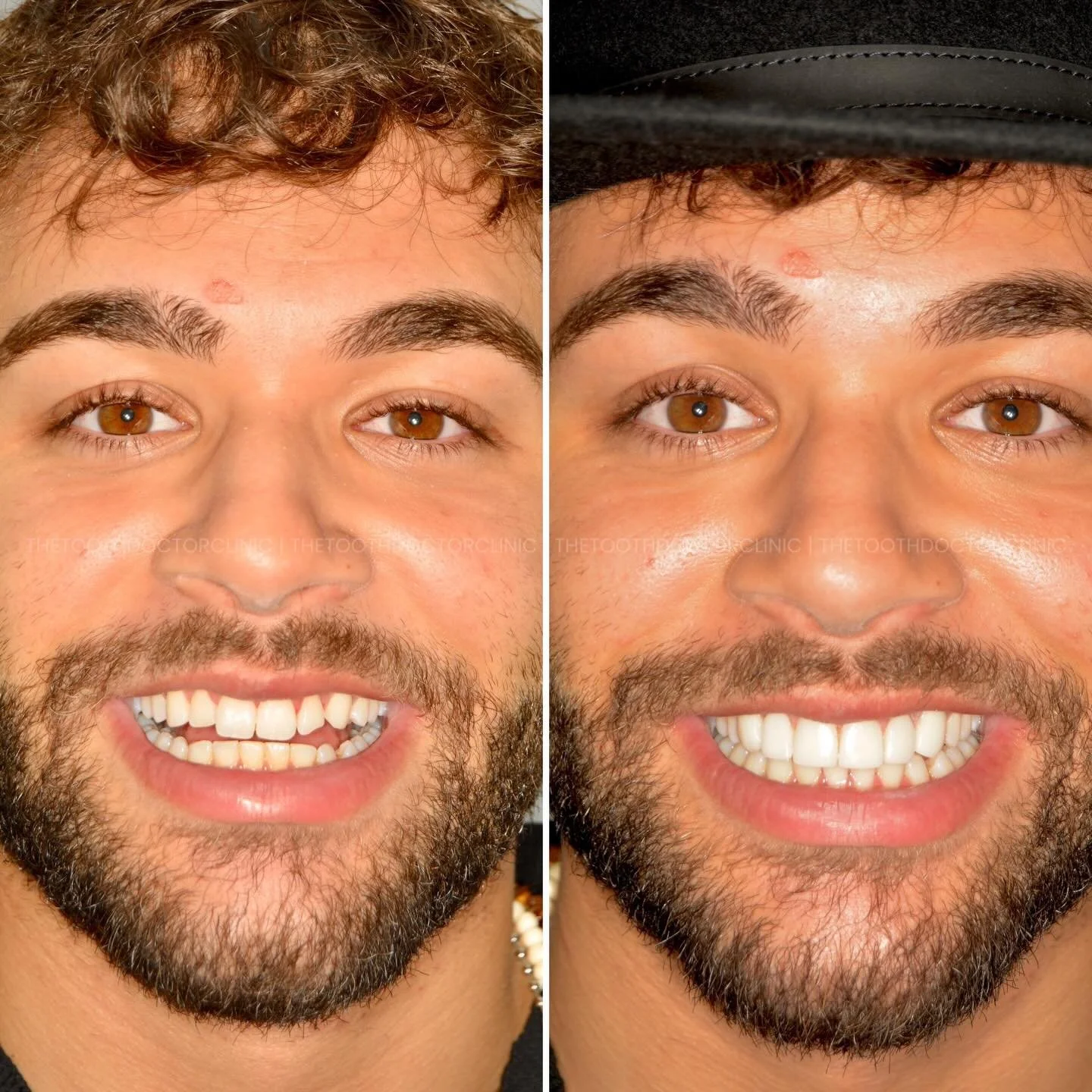 This patient attended the clinic unhappy with the shape of his teeth and the chipped tooth bothered him.

He wanted to enhance his smile and keep it looking natural.

We discussed various treatment options and decided to proceed with teeth whitening 