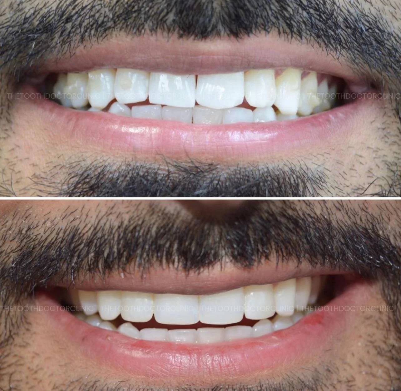 This patient wanted a 'straighter, nicer smile' so we worked our magic to create this result.

First, he underwent 12 weeks of Invisalign to straighten his teeth and then 2 weeks of home whitening, finished with composite bonding of the upper 4 front