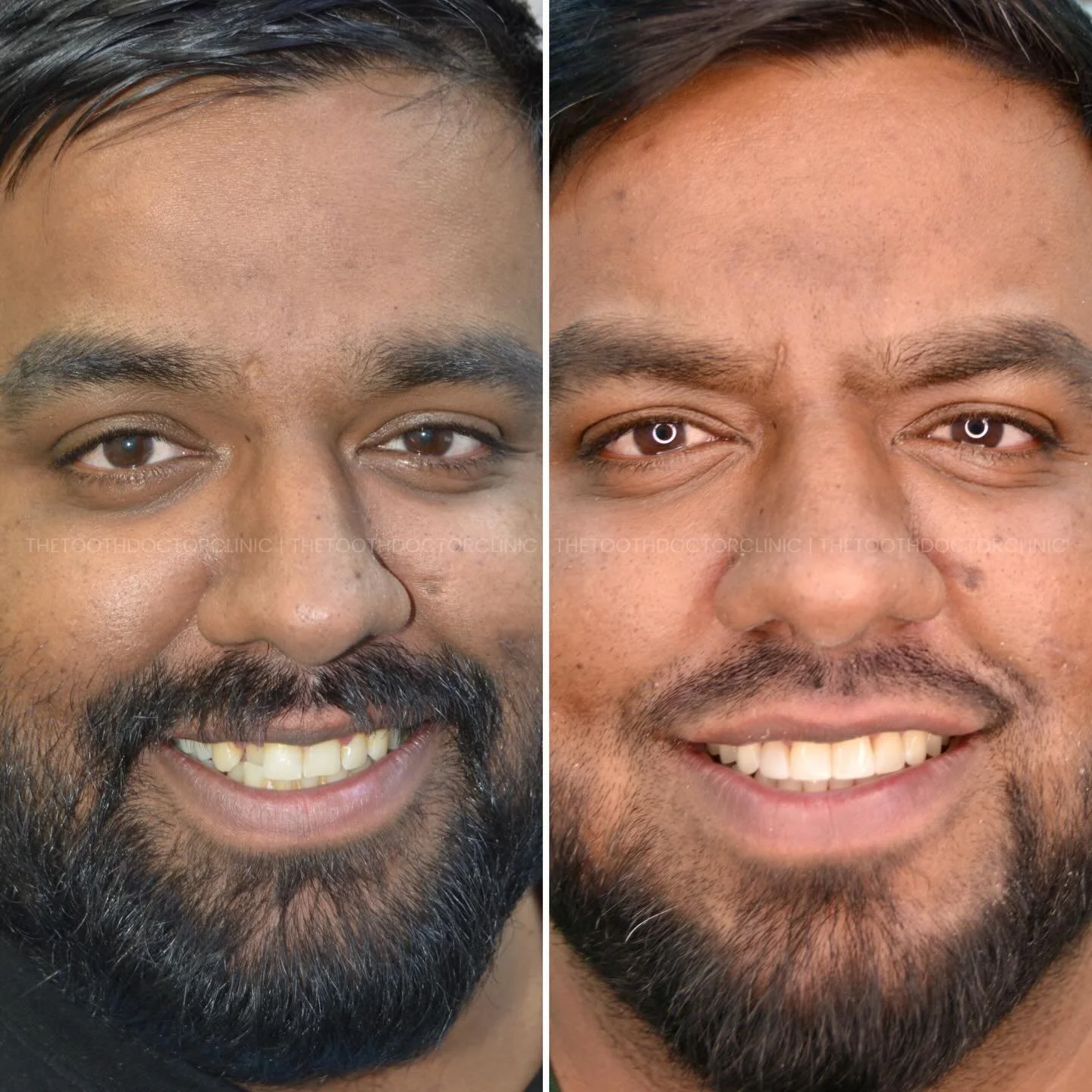 Another smile transformation 😁

Treatment undertaken: 
1. Treatment of periodontal disease
2. Invisalign 
3. Teeth whitening using @lumiwhiteteeth 
4. Composite bonding of the top 4 teeth 

#dentist  #invisalign #teethwhitening #birminghamdentist
#c