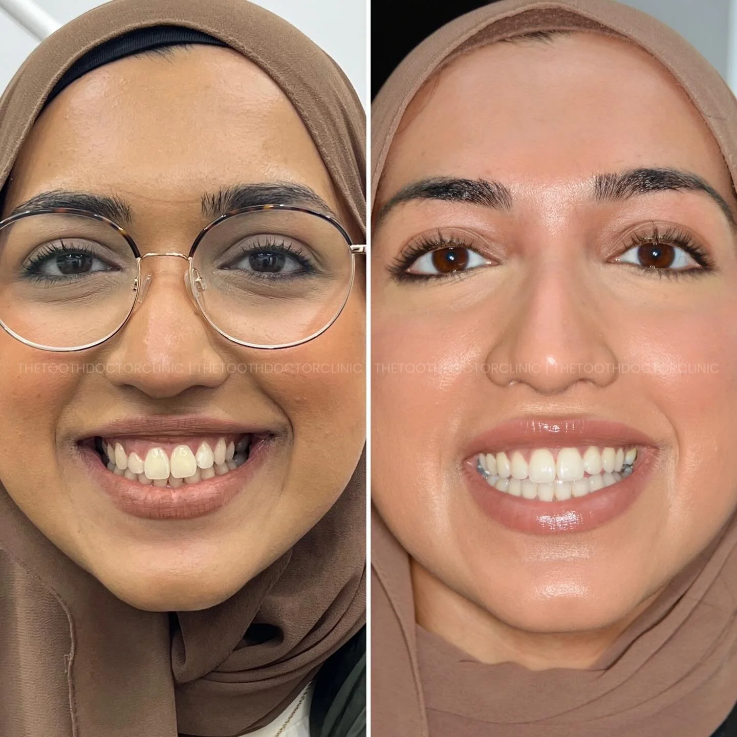A beautiful smile for a beautiful woman 😍

Treatment undertaken: 
1. Invisalign 
2. Teeth whitening using @lumiwhiteteeth 
3. Gum surgery 
4. Tooth contouring 

#dentist  #invisalign 
#teethwhitening #birminghamdentist
#compositebonding
