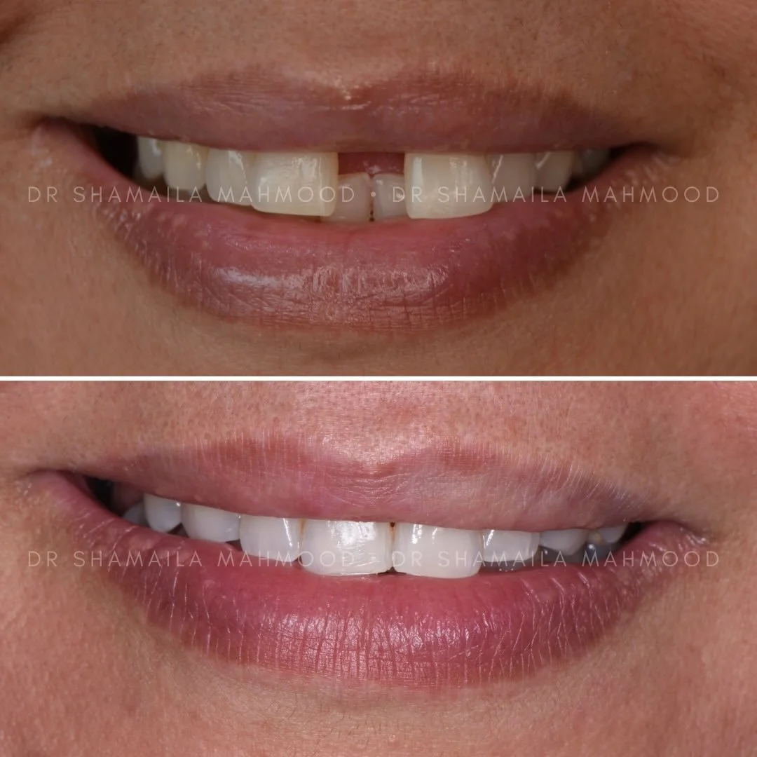From the first bracket to the final smile - what a transformation 🤍
So proud of this journey and these results!

#dentist  #invisalign 
#teethwhitening #birminghamdentist
#compositebonding