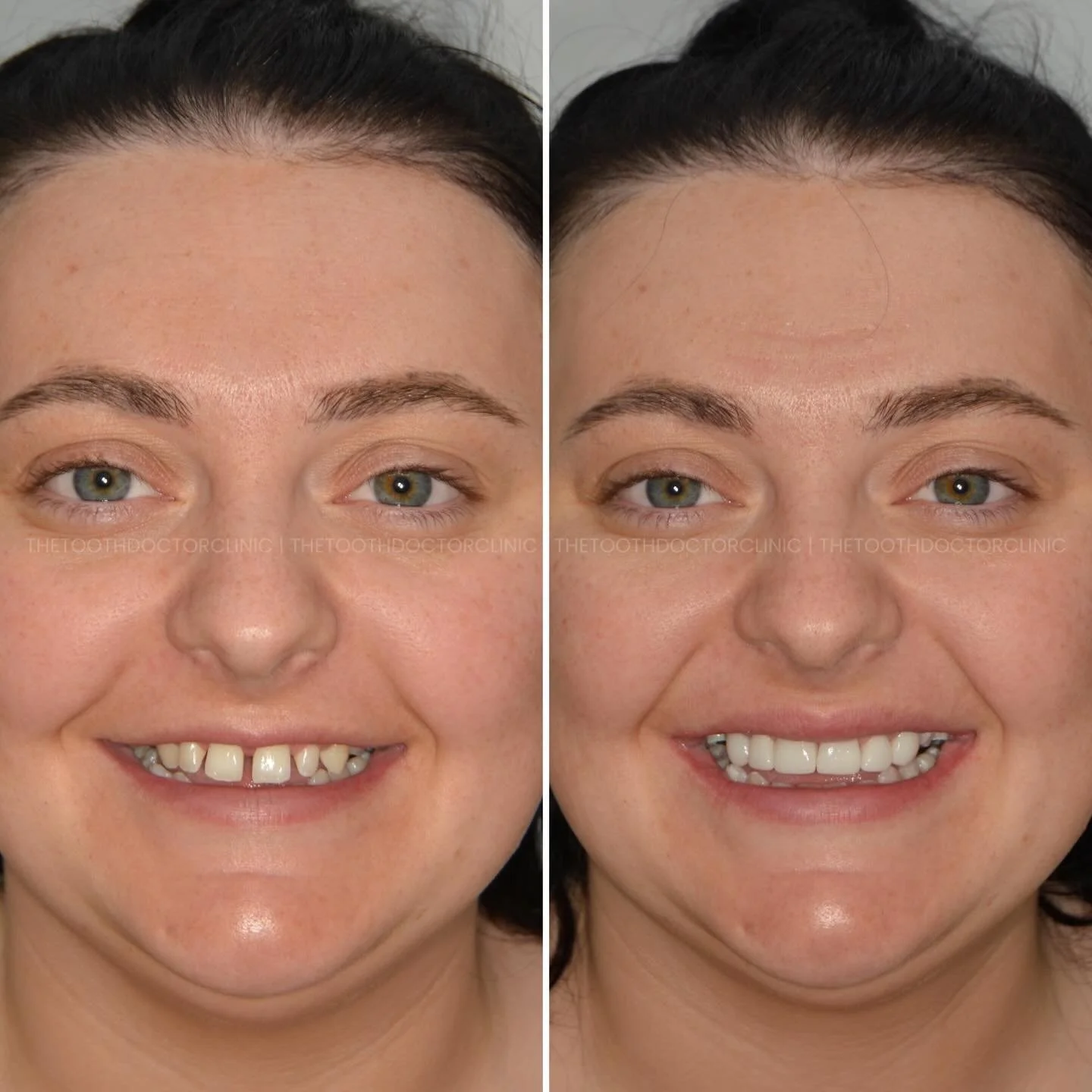 This lovely lady was concerned about the spaces between her teeth. She decided not to undergo orthodontic treatment and preferred to go ahead with composite bonding.

6 composite veneers were placed to mask the gaps, totally transforming her smile 😍