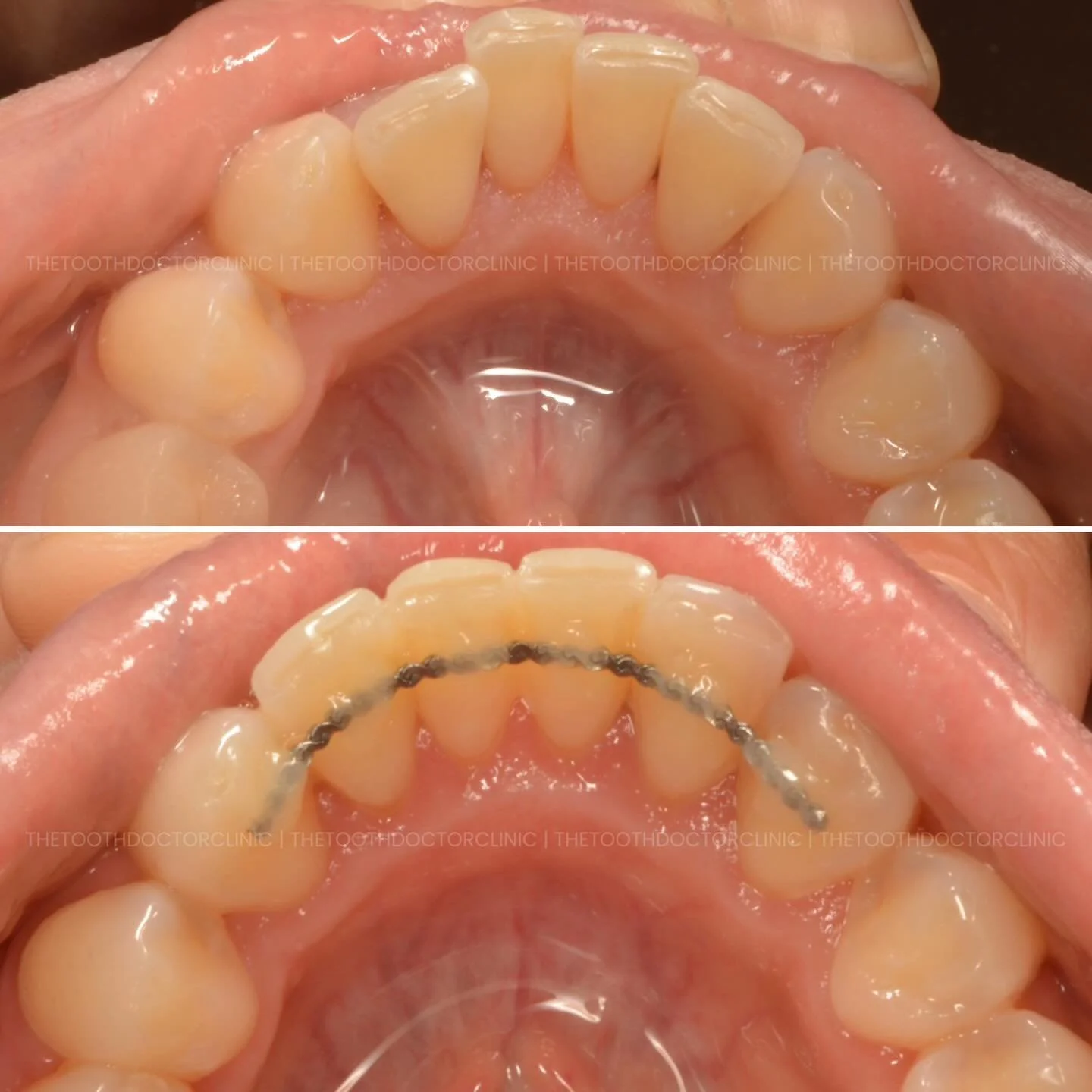 Before ➡️ After

Straightening your smile is just the first step - keeping it that way is just as important.

This fixed lingual retainer is discreetly bonded behind the teeth to maintain alignment after orthodontic treatment.
✔️ Invisible from the f