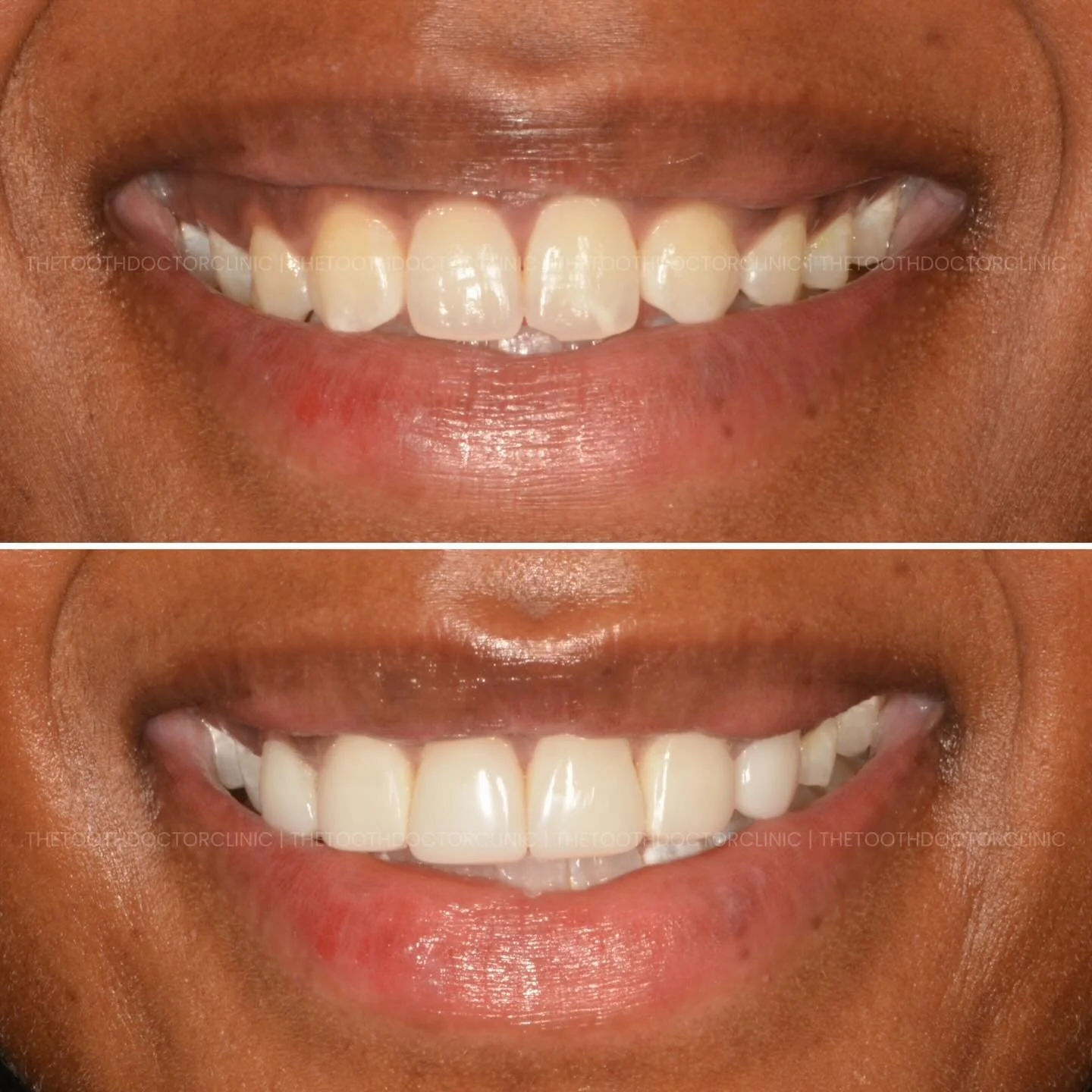 Composite bonding is a minimally invasive cosmetic treatment used to:
✔️ Repair chipped teeth
✔️ Close small gaps
✔️ Improve shape and symmetry
✔️ Enhance overall smile aesthetics

Carefully sculpted. Beautifully polished. Instantly confident.

Book 