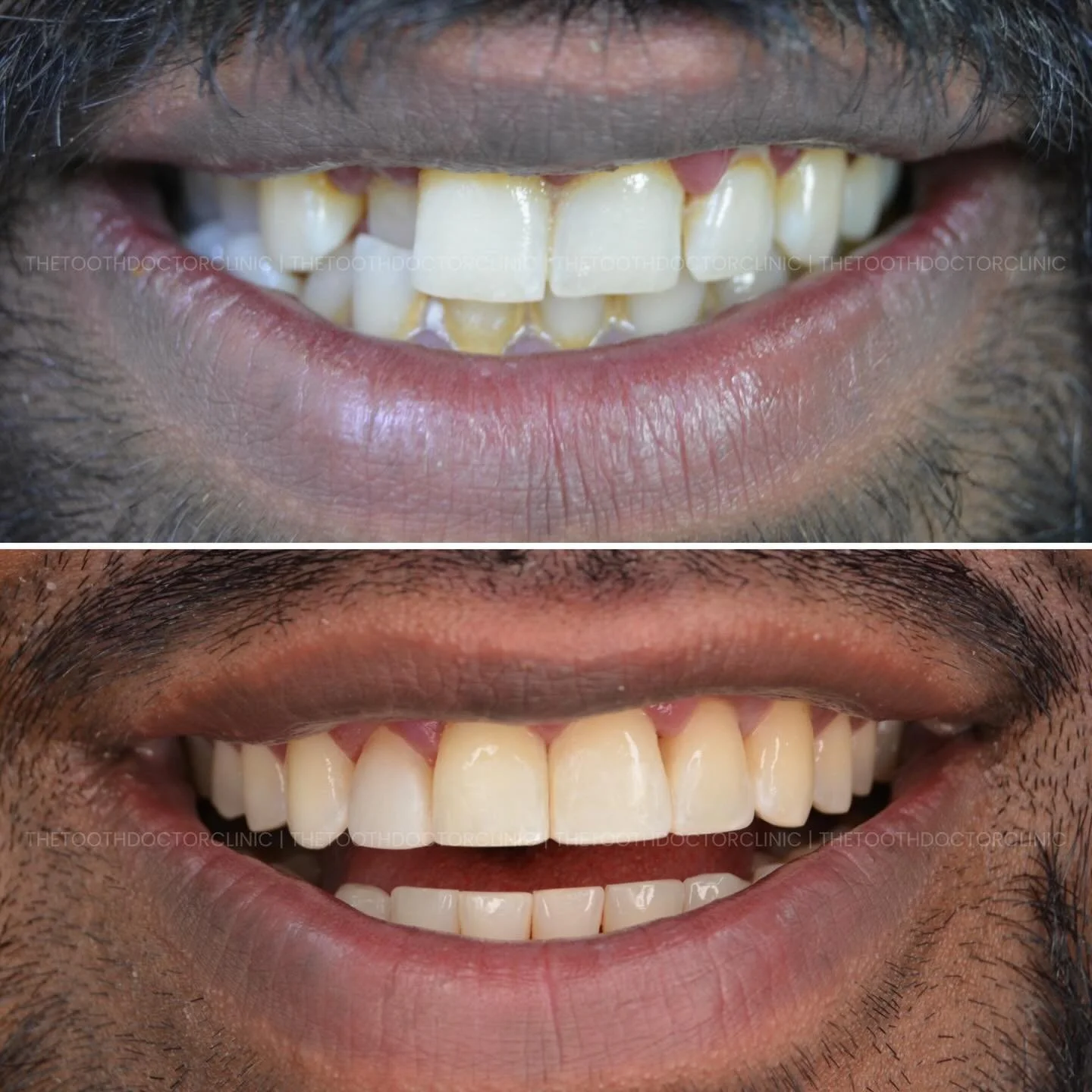 Subtle changes. Serious transformation. ✨

Periodontal treatment to restore gum health 🦷
Invisalign to align 🤍
Composite bonding to refine shape and symmetry 🎨

A healthier foundation, balanced proportions, and a natural finish that still looks li