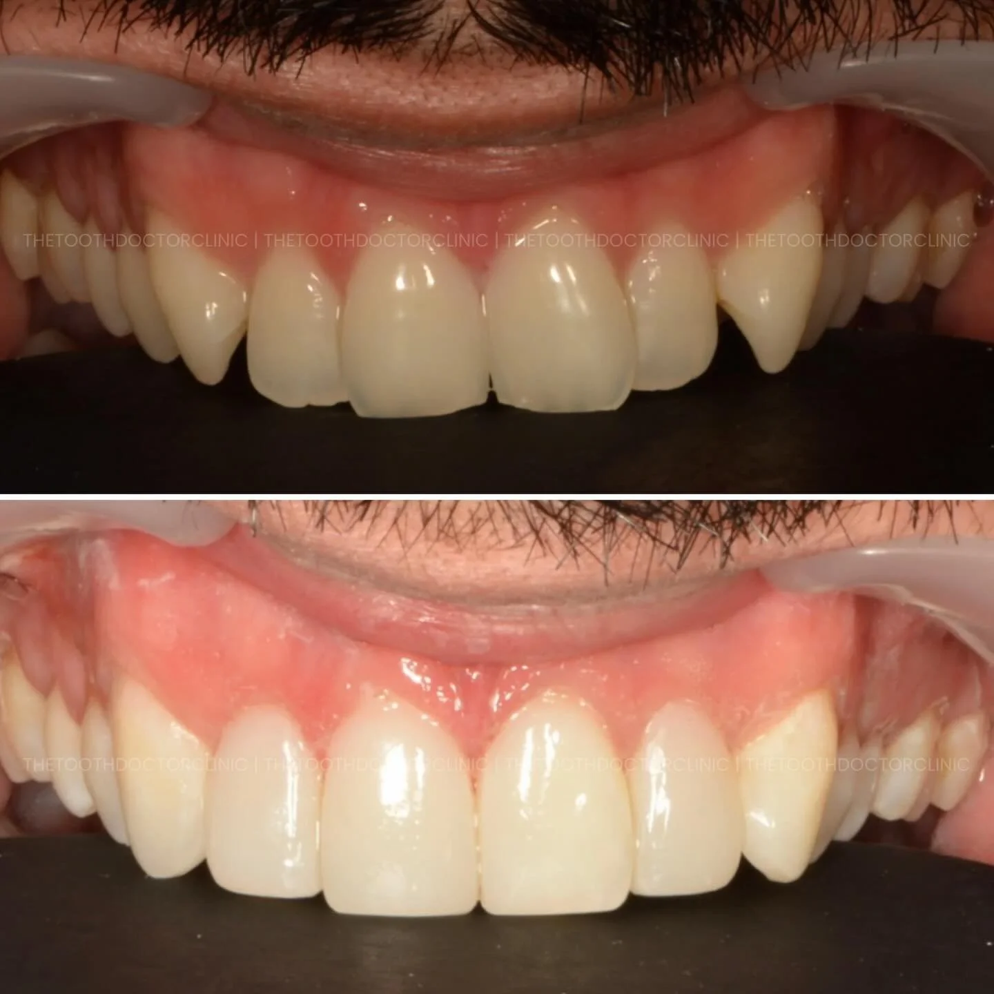 Wedding-ready smile for the groom 🤵🏻✨
Composite bonding to refine edges, close small gaps and enhance symmetry - subtle, natural and photo-ready for the big day 💍

#CompositeBonding #GroomSmile #BeforeAndAfter #SmileUpgrade