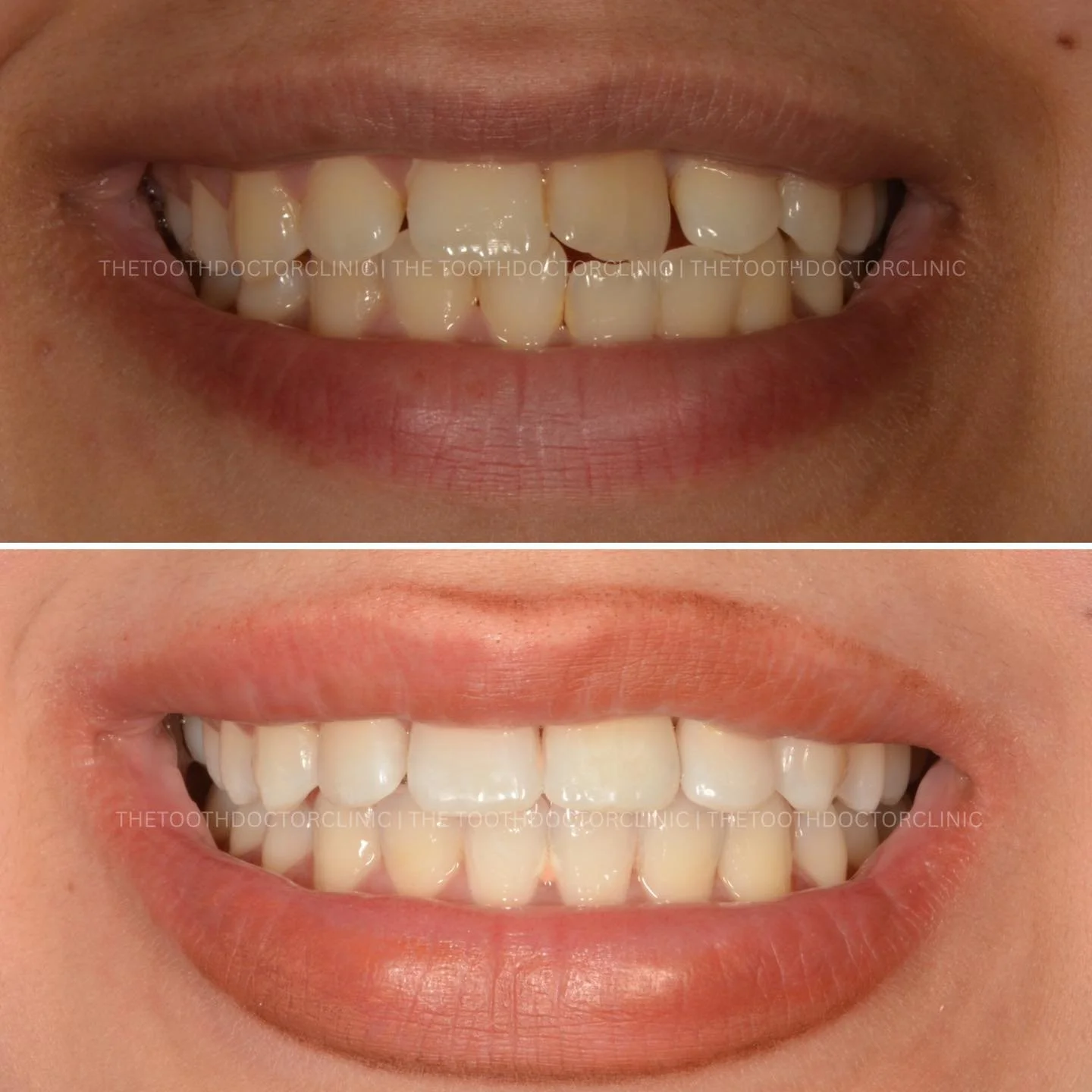 ✨ Invisalign transformation ✨ 

Subtle changes, big confidence boost 😁 
Straightening your smile has never been easier or more discreet. 

Ready to start your own smile journey? 

📲 Book online: www.thetoothdoctor.co.uk 
📞 0121 256 0441 

#Invisal