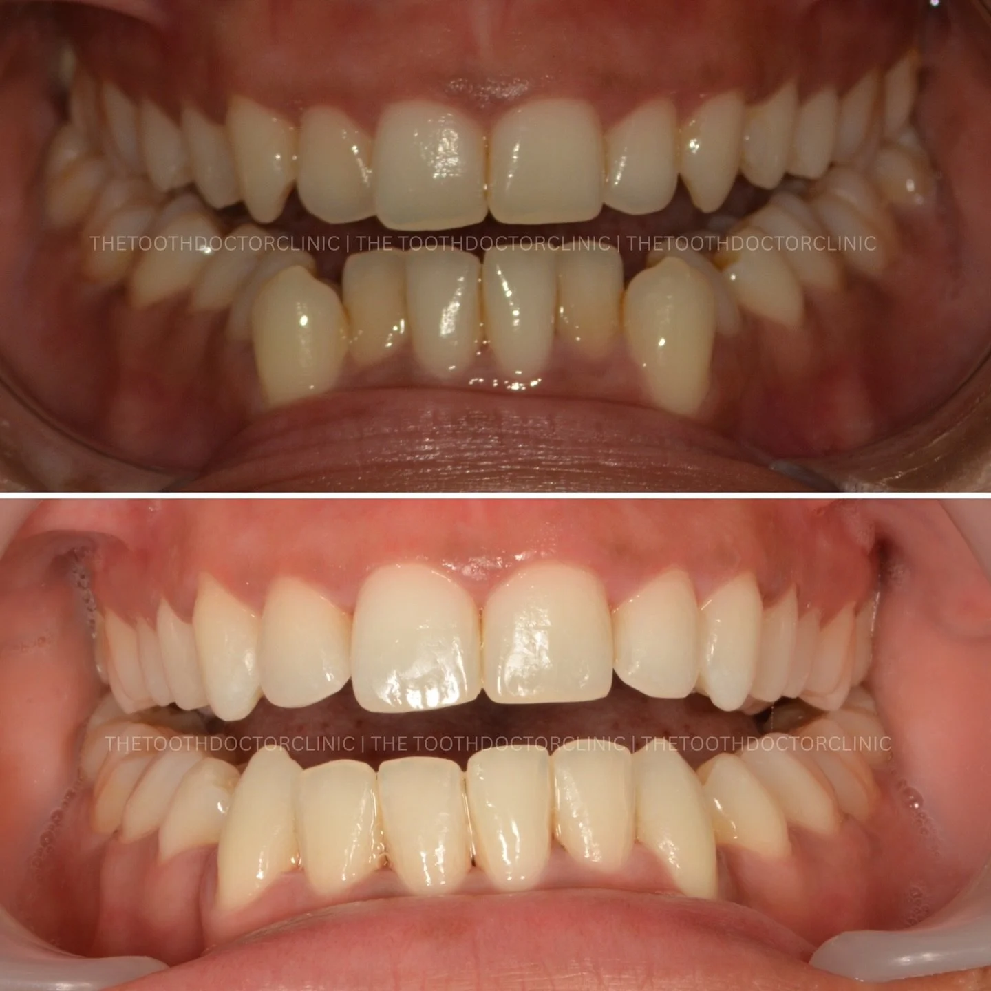 ✨ Clear Aligners Before &amp; After ✨ 

Crowded teeth, corrected 😁 
Carefully planned movements to create space and align your smile &mdash; all with nearly invisible aligners that fit around your lifestyle. 

Ready to transform your smile? ✨ 

📲 B