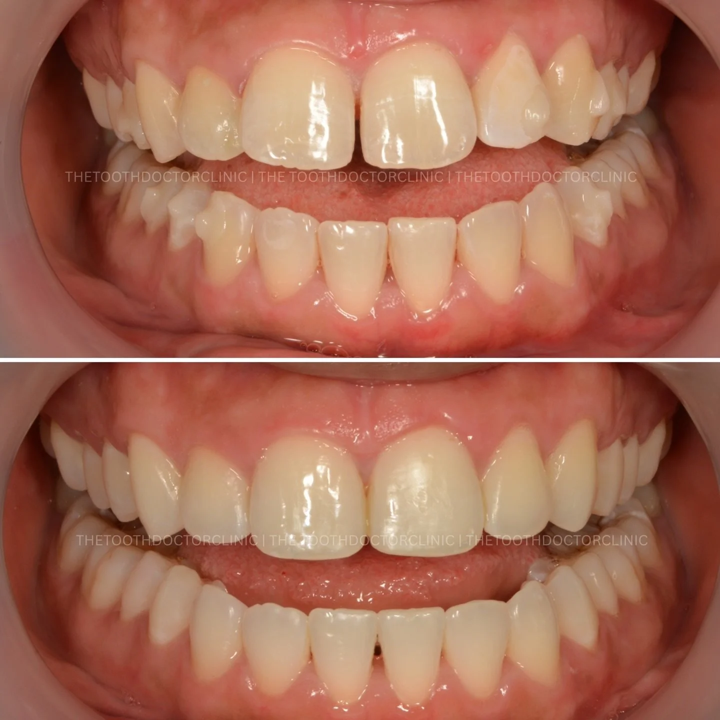 Closing gaps, enhancing confidence 😁 
Custom-made, discreet aligners gently guide your teeth into a more even, balanced smile. 

A seamless smile starts here ✨ 

📲 Book online: www.thetoothdoctor.co.uk 
📞 0121 256 0441 

#Invisalign #compositebond