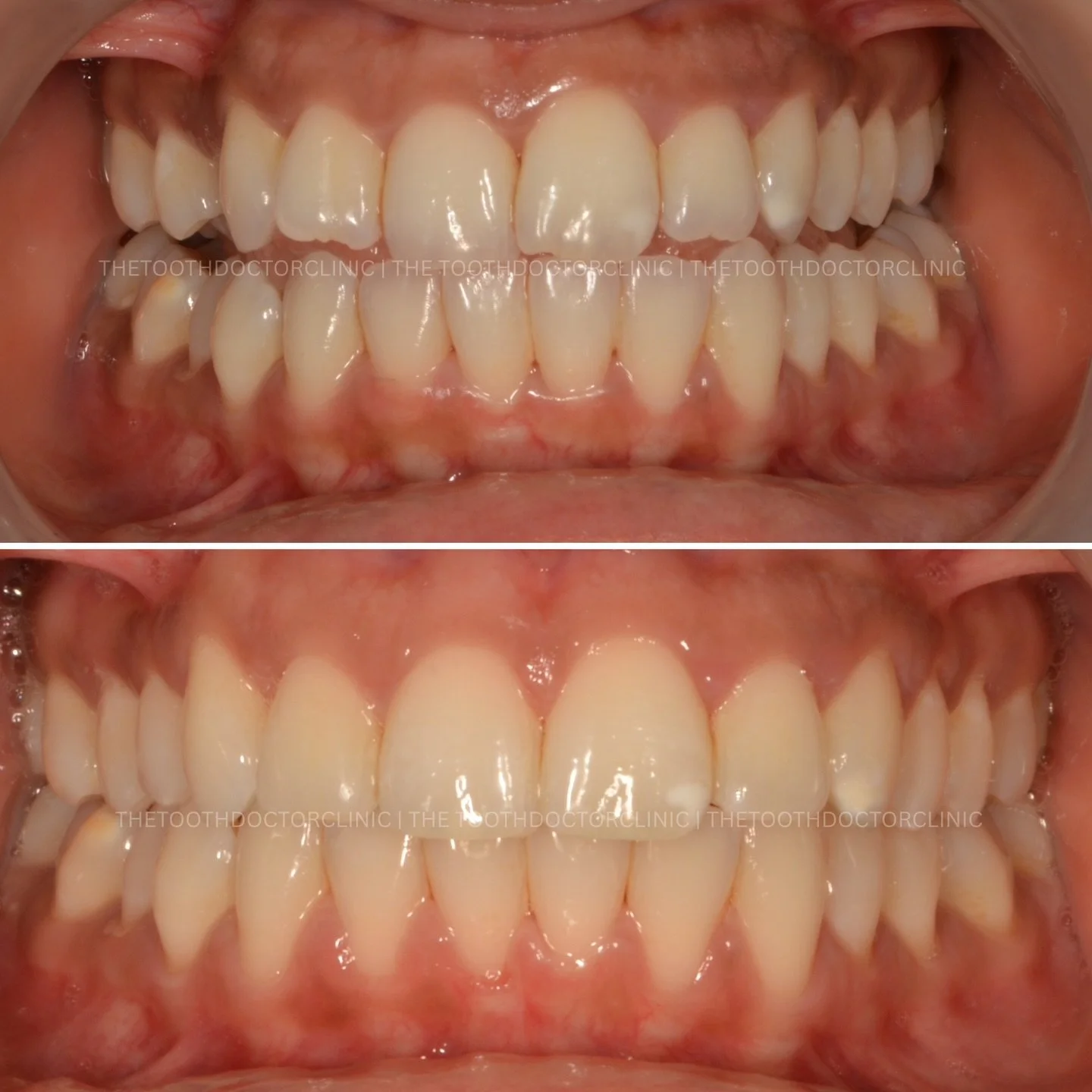 From crowded to confident 😁 
Gentle, controlled movements to create space and align your smile - all with nearly invisible aligners. 

Your smile, straightened your way ✨ 

📲 Book online: www.thetoothdoctor.co.uk 
📞 0121 256 0441 

#Invisalign #co