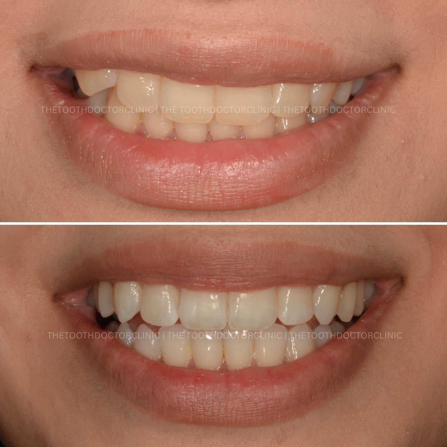 That one stubborn canine, perfectly aligned 😁 
Targeted, precise movements to bring crowded canines into position - all with discreet, removable aligners. 

Small adjustment, big difference ✨ 

📲 Book online: www.thetoothdoctor.co.uk 
📞 0121 256 0