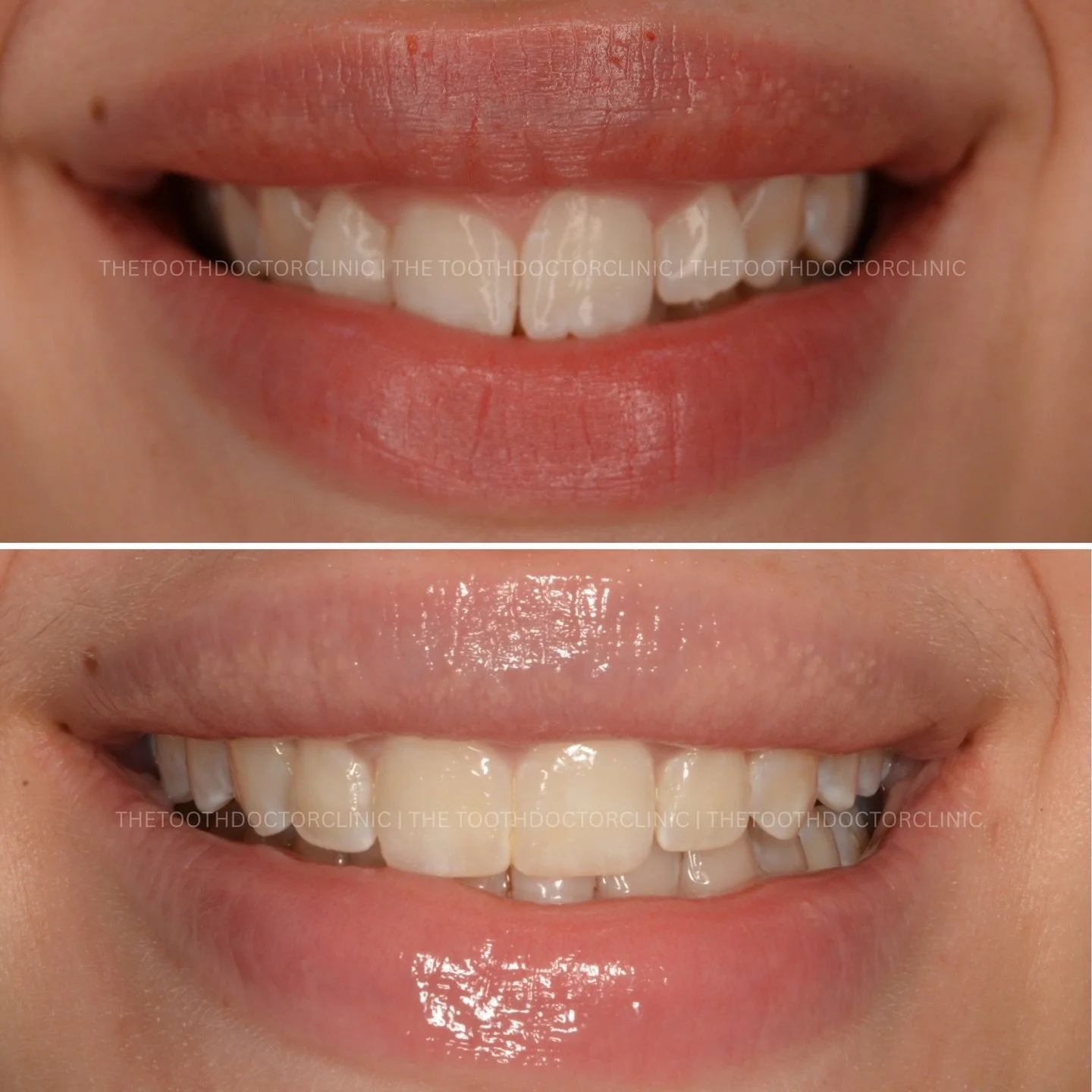 Aligned, refined, and beautifully balanced 😁 
Clear aligners to straighten, followed by subtle contouring to perfect the shape - the finishing touches make all the difference. 

A natural smile, elevated ✨ 

📲 Book online: www.thetoothdoctor.co.uk 