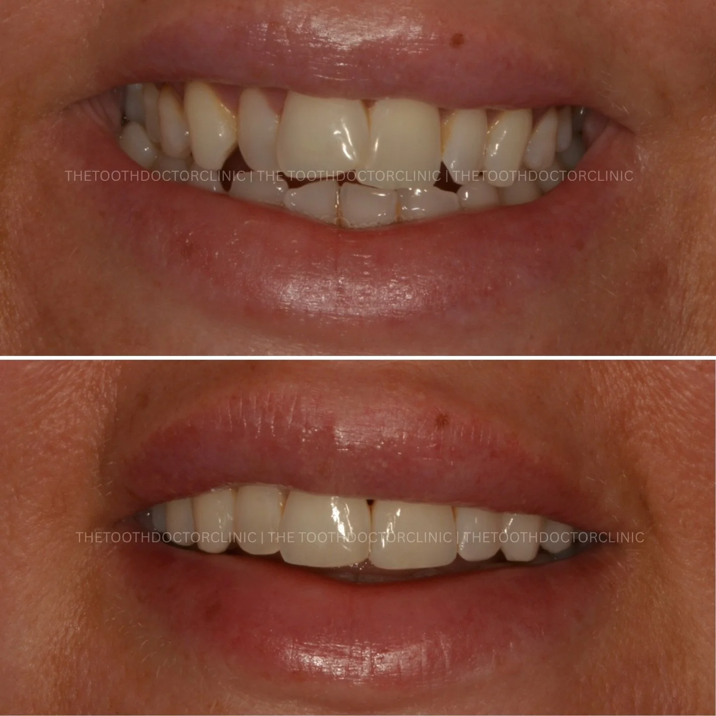 Crowding, corrected 😁 
Gently creating space and aligning your teeth with discreet, removable aligners designed around your lifestyle. 

A straighter, healthier smile starts here ✨ 

📲 Book online: www.thetoothdoctor.co.uk 
📞 0121 256 0441 

#Invi