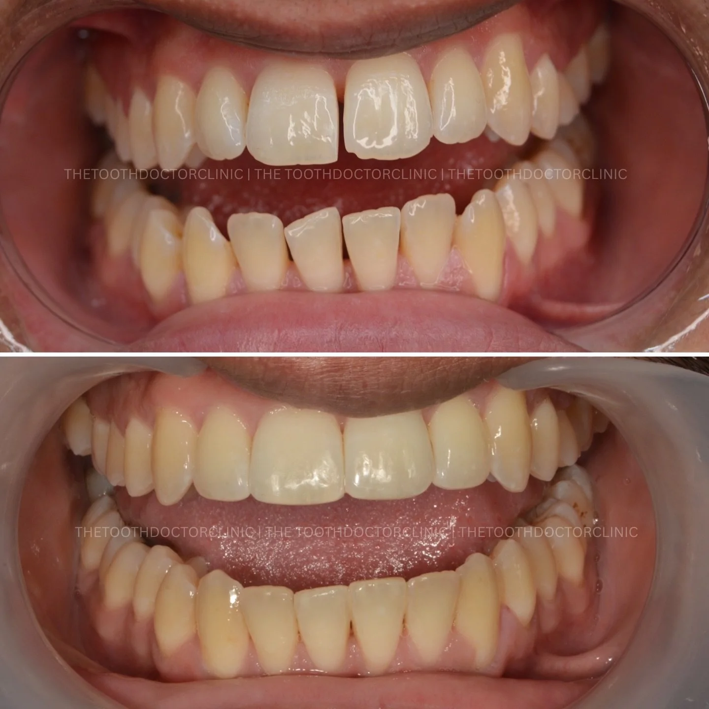 Closing gaps, creating confidence 😁 
Discreet, custom-made aligners gently bring your teeth together for a more even, balanced smile. 

Say goodbye to unwanted spaces ✨ 

📲 Book online: www.thetoothdoctor.co.uk 
📞 0121 256 0441 

#Invisalign #comp