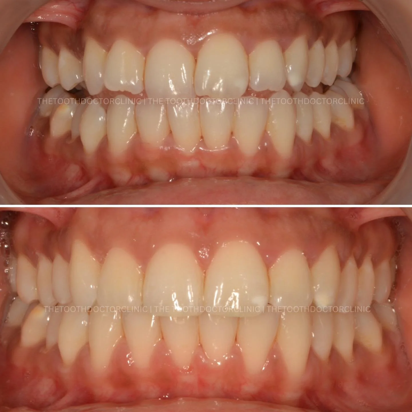 ✨ Clear Aligners Before &amp; After ✨ 

Small movements, stunning results 😁 
Discreet, comfortable, and tailored to you &mdash; your perfect smile starts here. 

Thinking about straightening your teeth? Let&rsquo;s make it happen. 

📲 Book online: 
