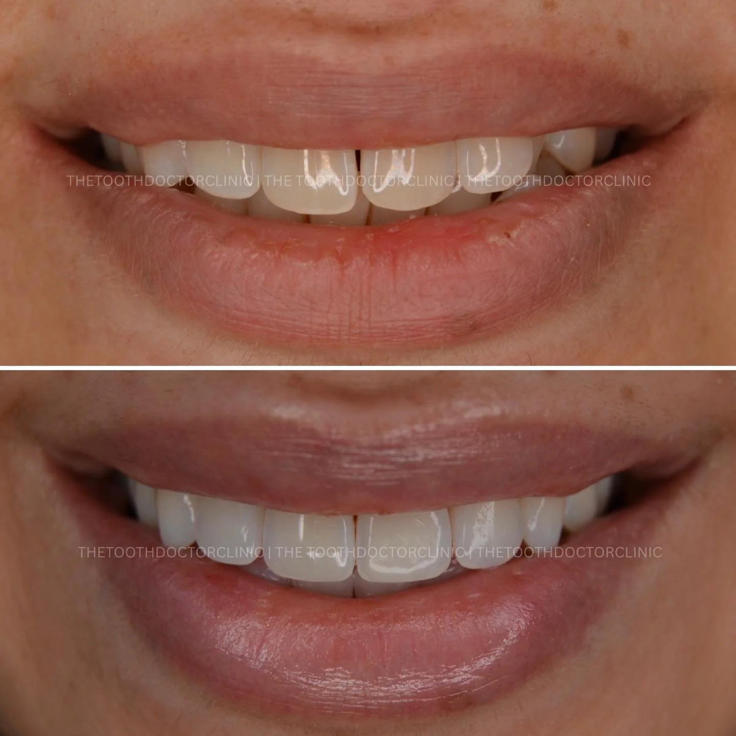 ✨ Clear Aligners Before &amp; After ✨ 

From subtle shifts to confident smiles 😁 
Custom-made, nearly invisible and designed to fit around your lifestyle. 

Your smile, but better ✨ 

📲 Book online: www.thetoothdoctor.co.uk 
📞 0121 256 0441 

#Inv