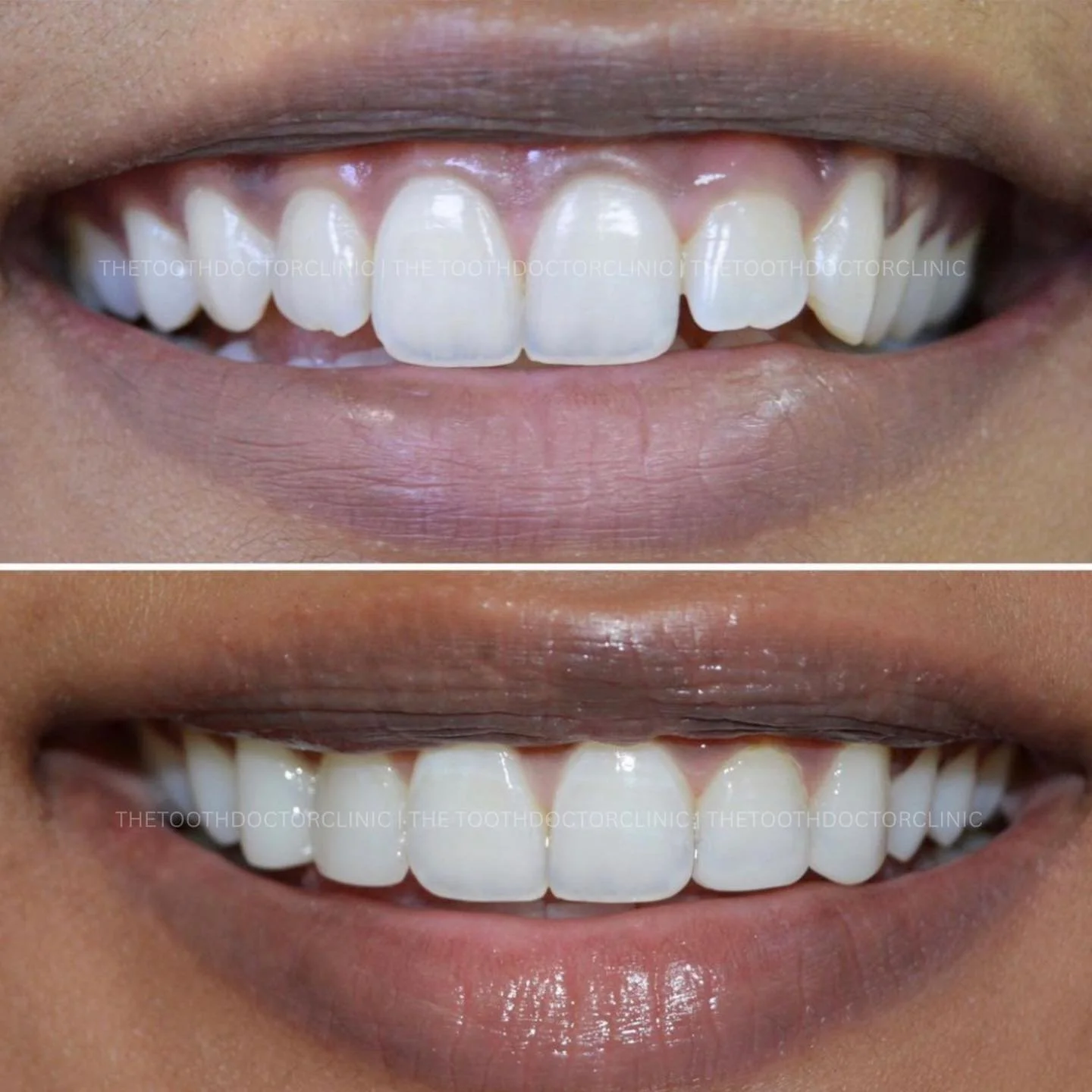 ✨ Composite Bonding Before &amp; After ✨ 

Small changes, big difference 😁 
Enhancing shape and creating a natural, confident smile in just one visit. 

Ready for your smile glow up? ✨ 

📲 Book online: www.thetoothdoctor.co.uk 
📞 0121 256 0441 

#