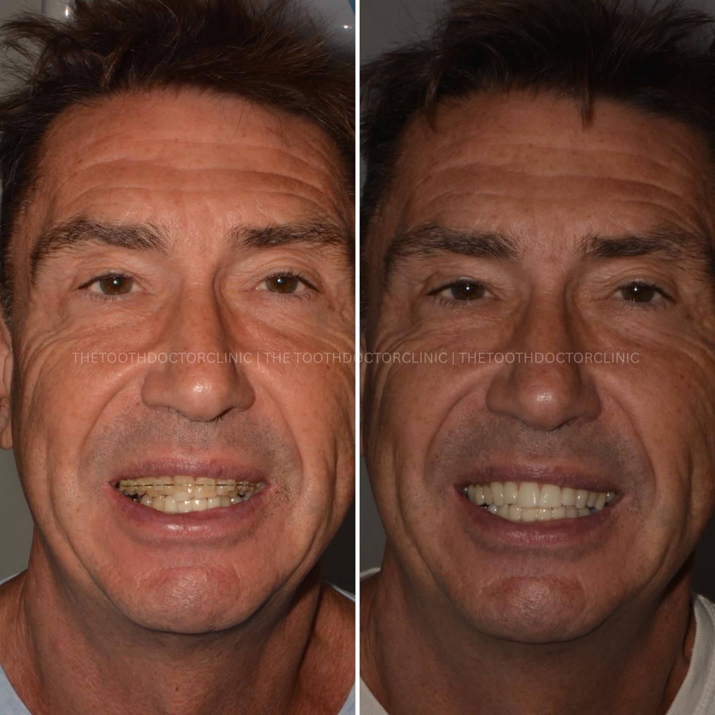 ✨ From crowded to confident 😁 
Precise, effective tooth straightening for a beautifully aligned smile that lasts. 

Ready to transform your smile? ✨ 

📲 Book online: www.thetoothdoctor.co.uk 
📞 0121 256 0441 

#Invisalign #compositebonding #mosele