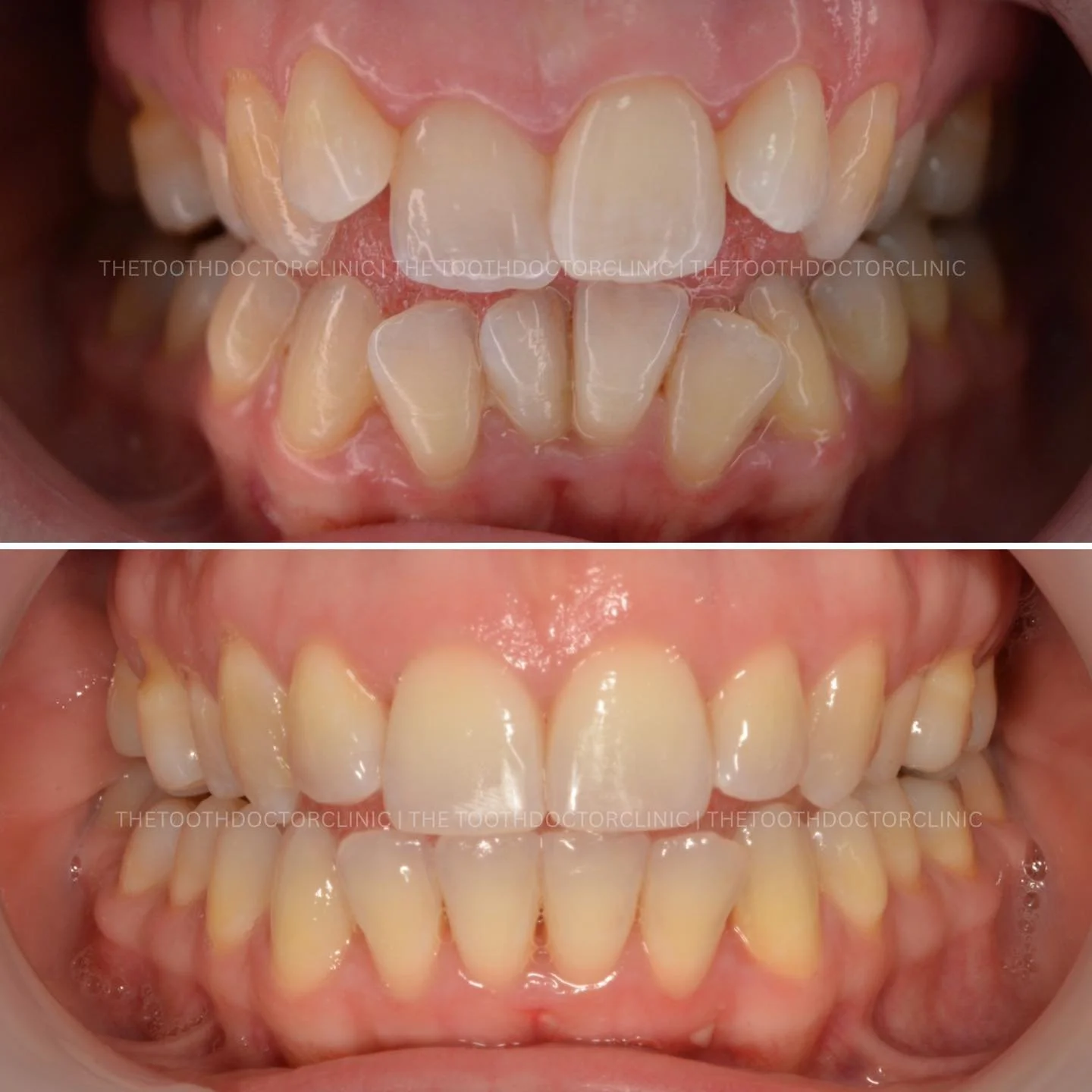✨ Clear Aligners Before &amp; After ✨ 

Crowded teeth transformed into a beautifully aligned smile 😁 
Gentle, precise movements to create space and balance - all with discreet, removable aligners. 

Ready to straighten your smile? ✨ 

📲 Book online