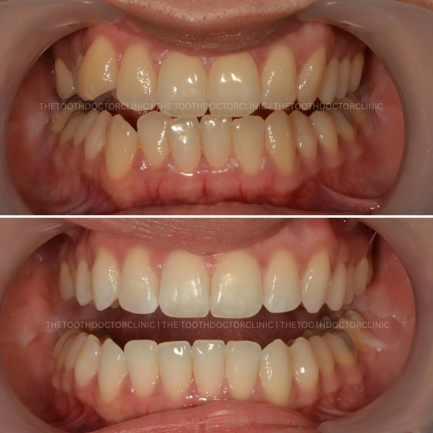 ✨ Clear Aligners Before &amp; After ✨ 

From crowded teeth to a beautifully aligned smile 😁 
Gentle, controlled movement to create space, harmony, and a confident new look &mdash; all with discreet clear aligners. 

Your new smile starts here ✨ 

📲