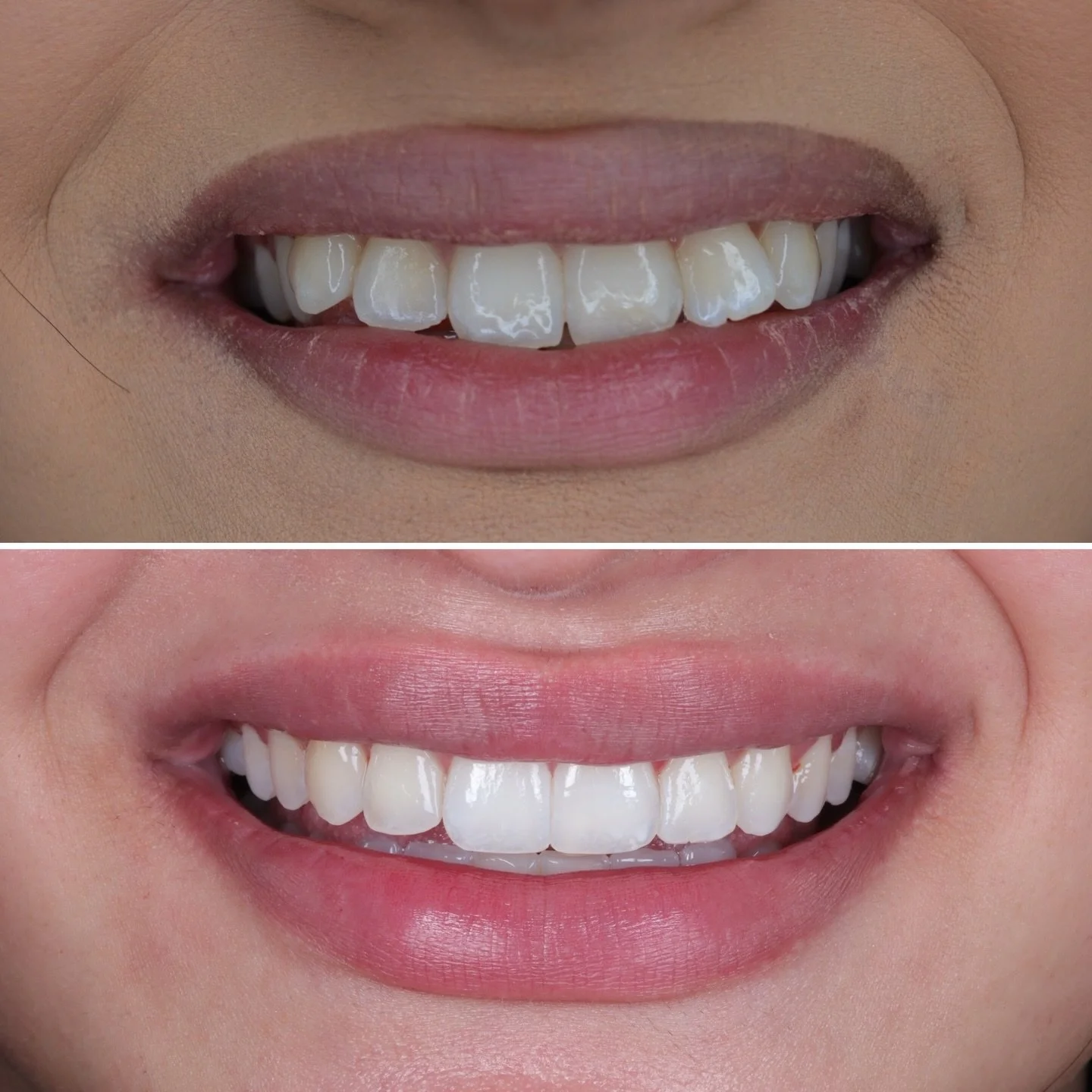Subtle changes. Big difference. ✨
Results that speak for themselves.

Book your consultation today:
www.thetoothdoctor.co.uk
📞 0121 256 0441

#moseley #birminghamdentist #compositebonding #teethstraightening #dentist