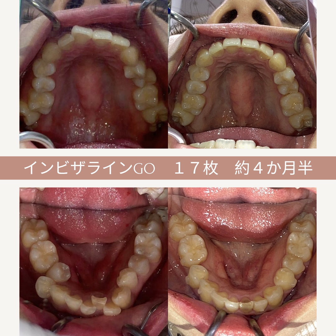 左上と右上に上顎の歯列を写し、左下と右下に下顎の歯列を写している。歯列は歯科矯正の前後の比較で、17枚のインビザラインの治療経過を示している。