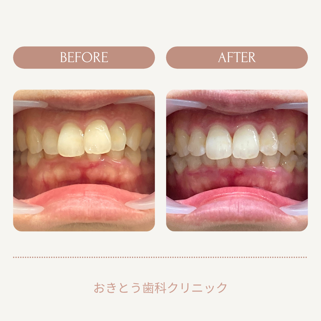 歯の矯正施術前と後の比較写真。上の歯の歯並びが改善されている。下に「おきとう歯科クリニック」と書かれている。