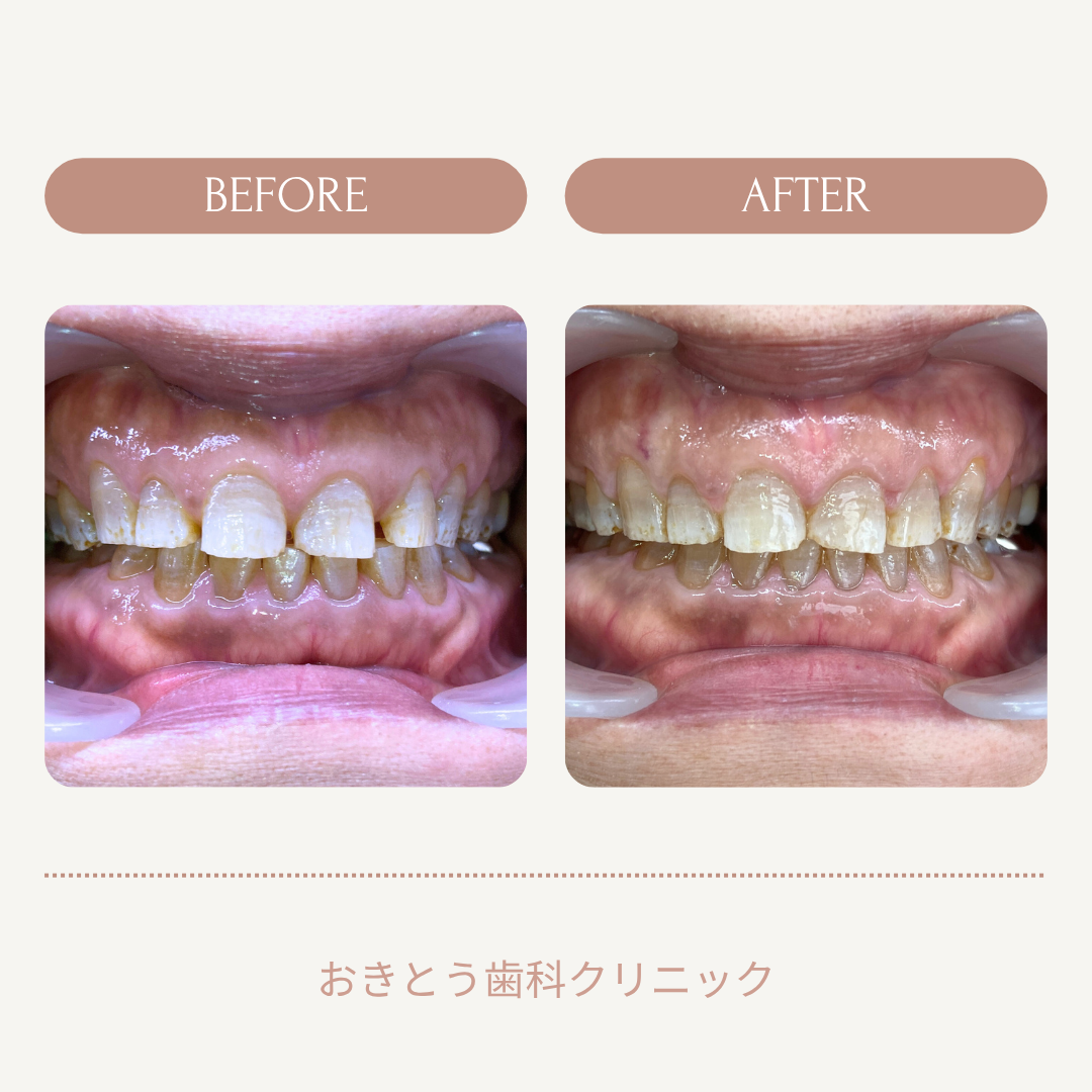 歯のホワイトニングのビフォーアフターの比較写真。左側は黄ばんで汚れが目立つ歯で右側は清潔で明るい歯。おきとう歯科クリニックのロゴが入り、背景は淡いベージュ色。