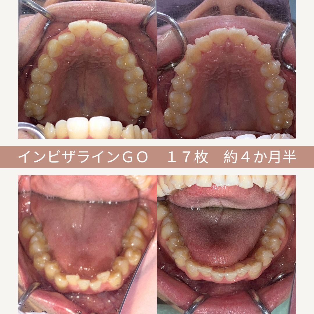 歯科治療の前後の写真。上は上顎の歯、下は下顎の歯の比較。インビザラインGOで約4か月半、17枚のマウスピースを使用した結果。