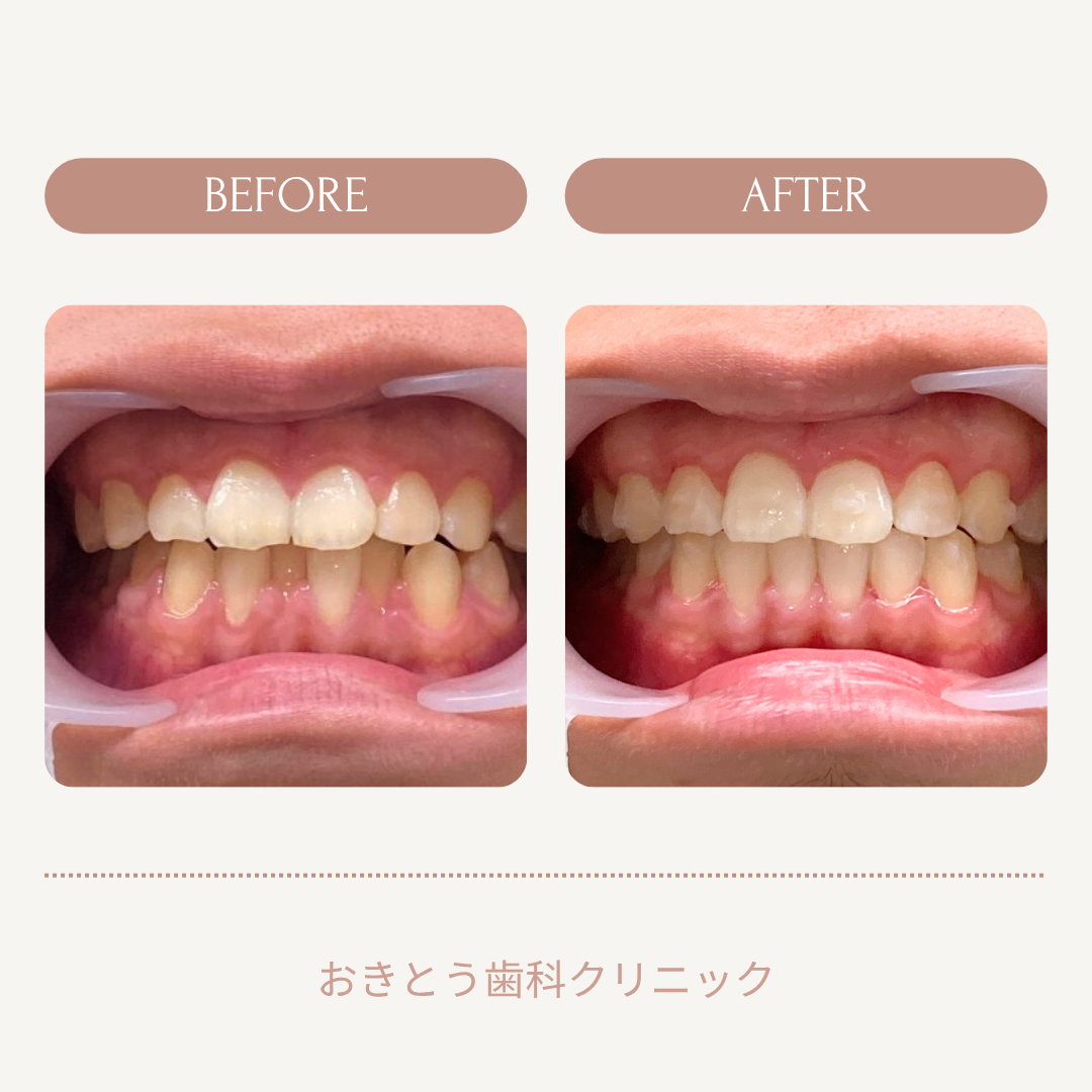 歯の矯正治療前と治療後の比較写真。左側が治療前、右側が治療後。歯並びが改善されている。