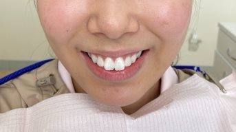 Close-up of a smiling person showing their teeth, with part of their face and neck visible.