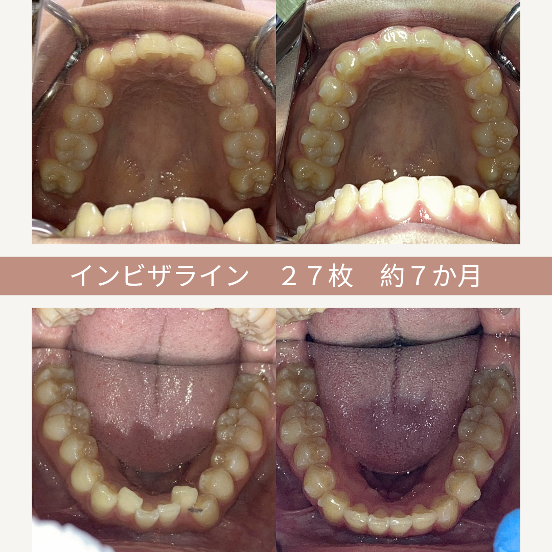 上と下の歯のインビザライン治療前後の比較写真。左側は治療前の歯、右側は約7か月後の歯並び改善が見られる。