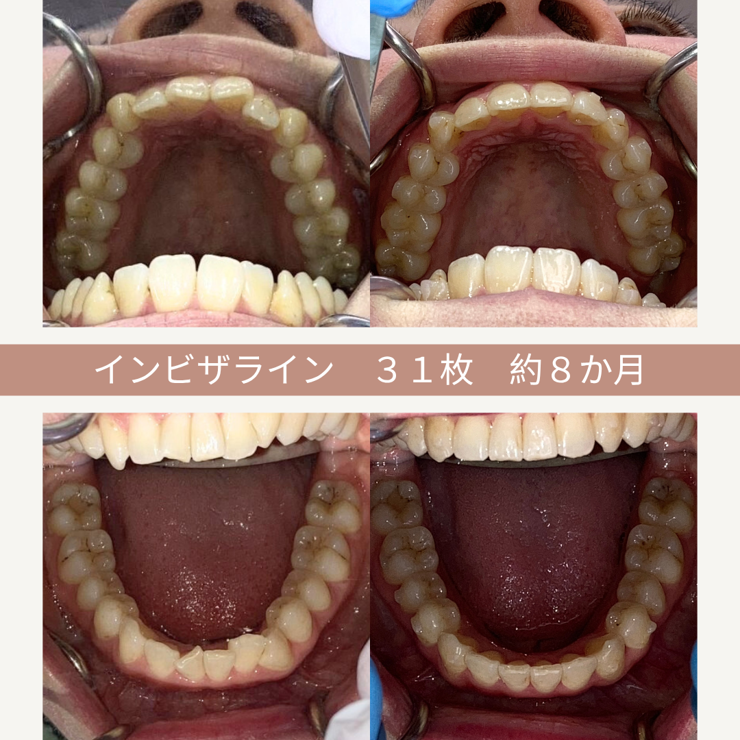 インビザライン治療を受けた患者の歯の写真。施術前と後の比較で、約8か月で31枚のインビザラインを使用しています。上顎と下顎の歯列の変化が写っています。