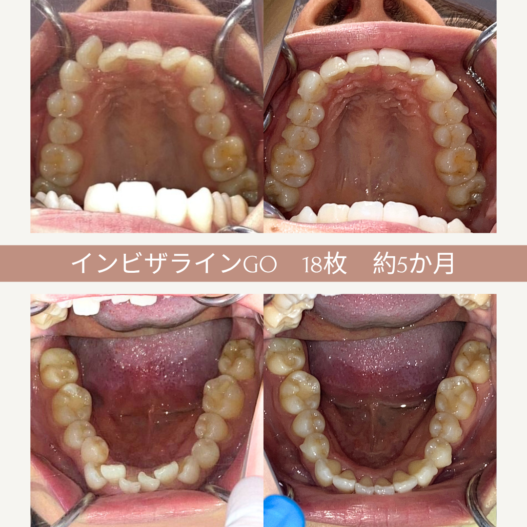 歯列矯正のビフォーアフター比較写真。上顎と下顎の内側から見た歯の状態。左側が施術前、右側が施術後で、約5ヶ月間のインビザラインGOによる治療。
