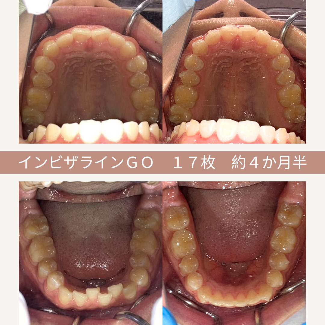 口の中の歯の矯正治療の前後の写真。上顎と下顎の歯列を比較している。テキストは「インビザラインGO 17枚 約4か月半」