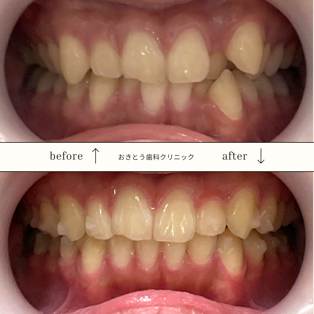 歯の矯正治療のビフォーアフターの写真。上段は矯正前で歯が重なり合っている。下段は矯正後で歯並びが改善されている。