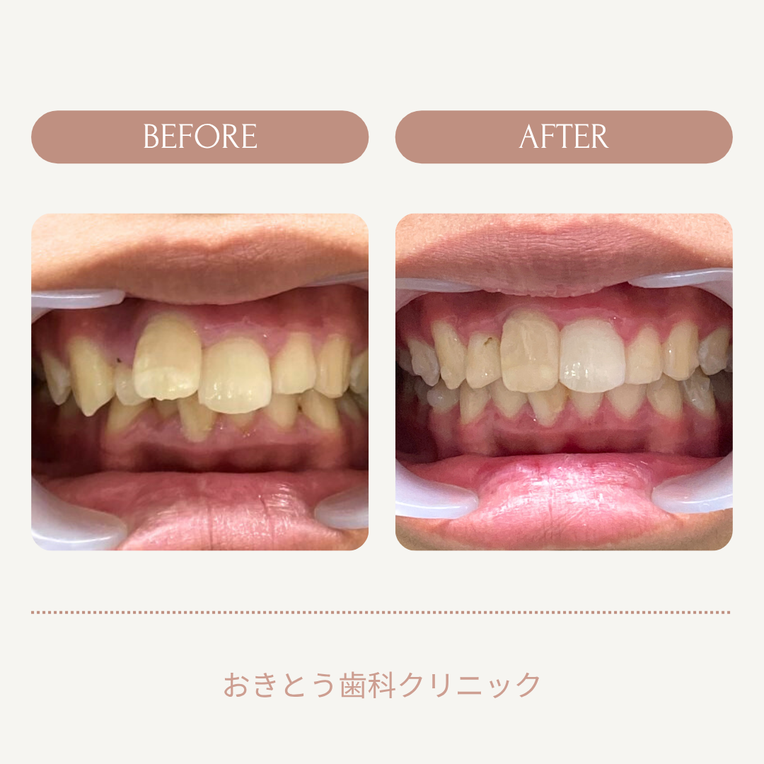 歯の矯正前後の比較写真。左側は歯並びが乱れている。右側は歯並びが改善されている。