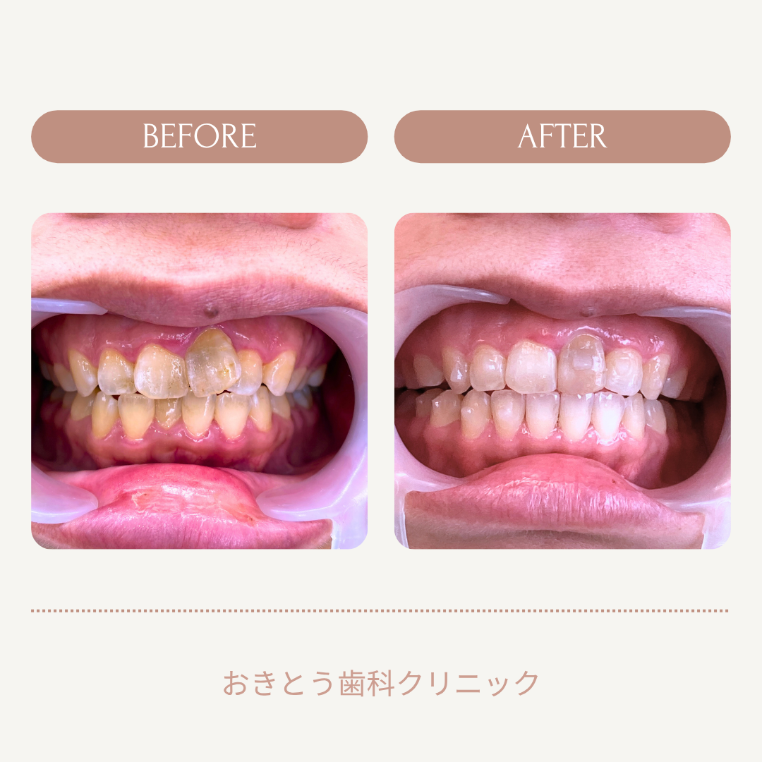 歯のビフォーアフターの写真。左側は乱れた歯並びと歯の着色、右側は整った歯並びと白くきれいな歯になっている。