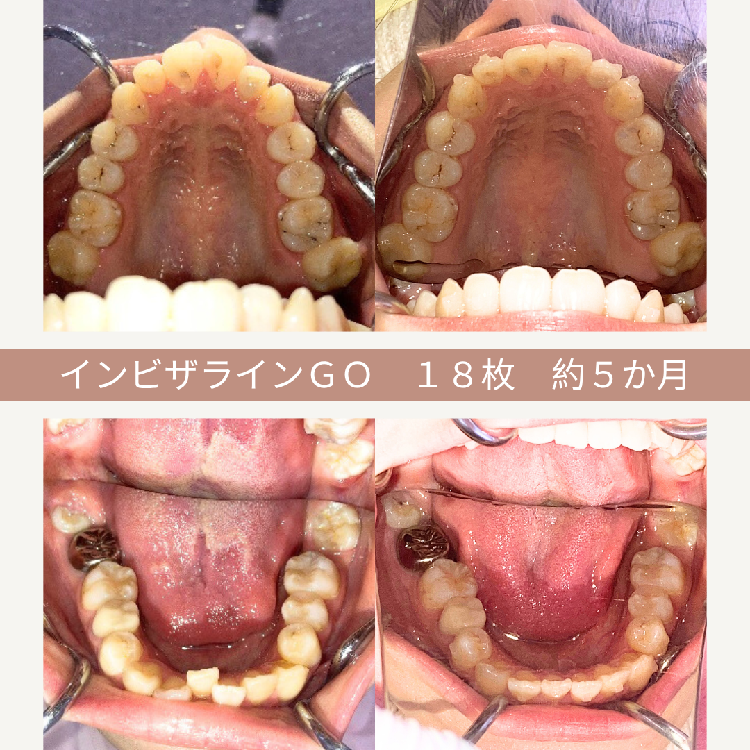 上下の歯と舌を検査している4枚の歯科検査写真。中央にはインビザラインGOの治療後約5ヶ月、18枚のマウスピースを使用した結果の比較写真。