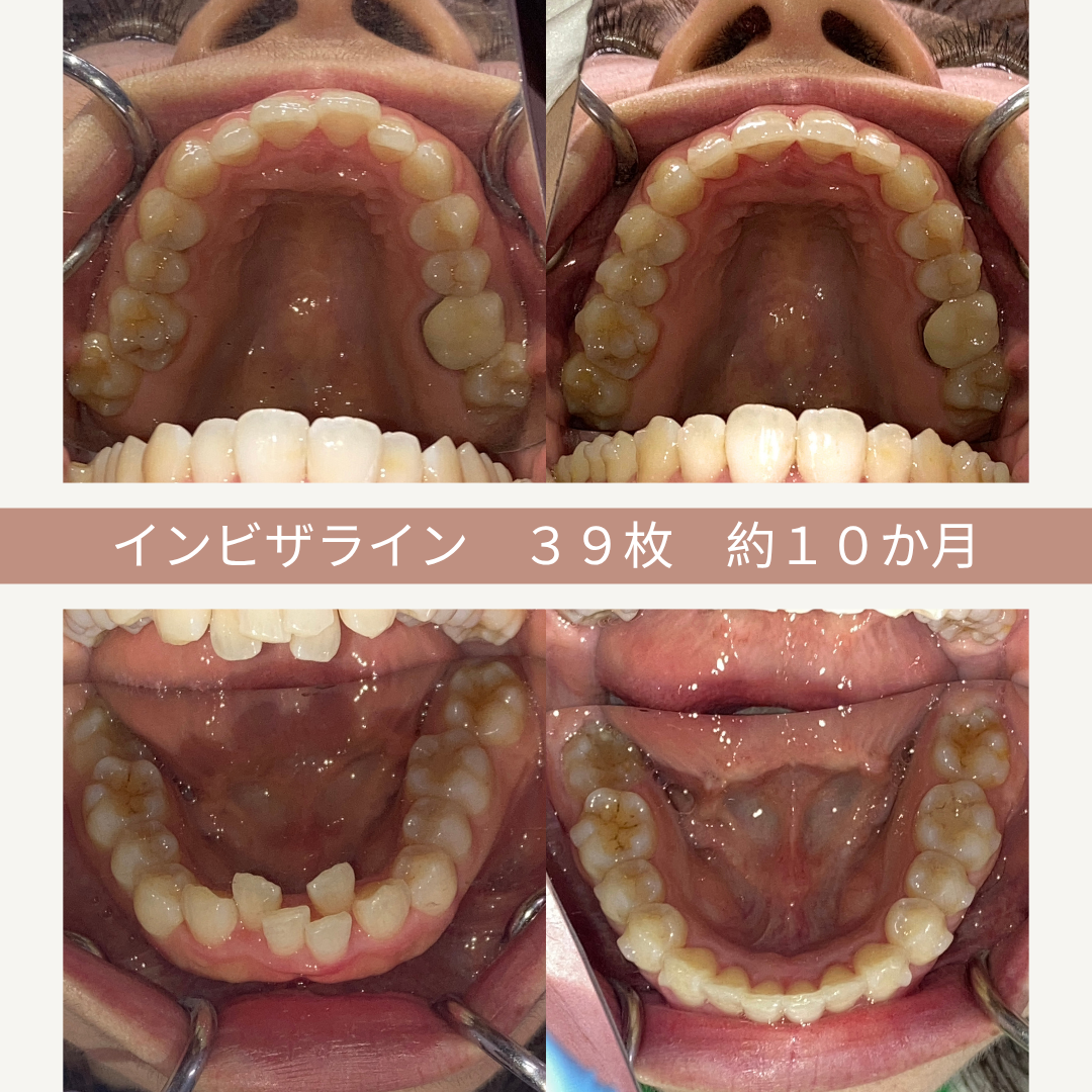 上段の歯列と下段の歯列の比較写真。インビザライン治療後に39枚のアライナーを使用し、約10か月かかった歯の矯正結果が示されている。