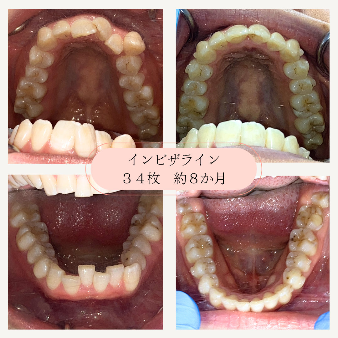インビザライン装着後の上下の歯の写真。34枚のアライナーを約8ヶ月使用した結果を示している。